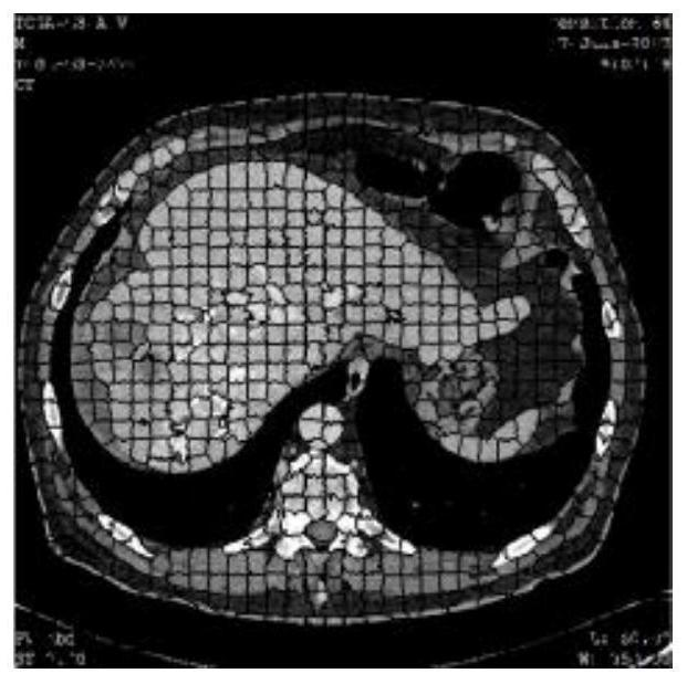 Liver CT image tumor segmentation method based on information fusion