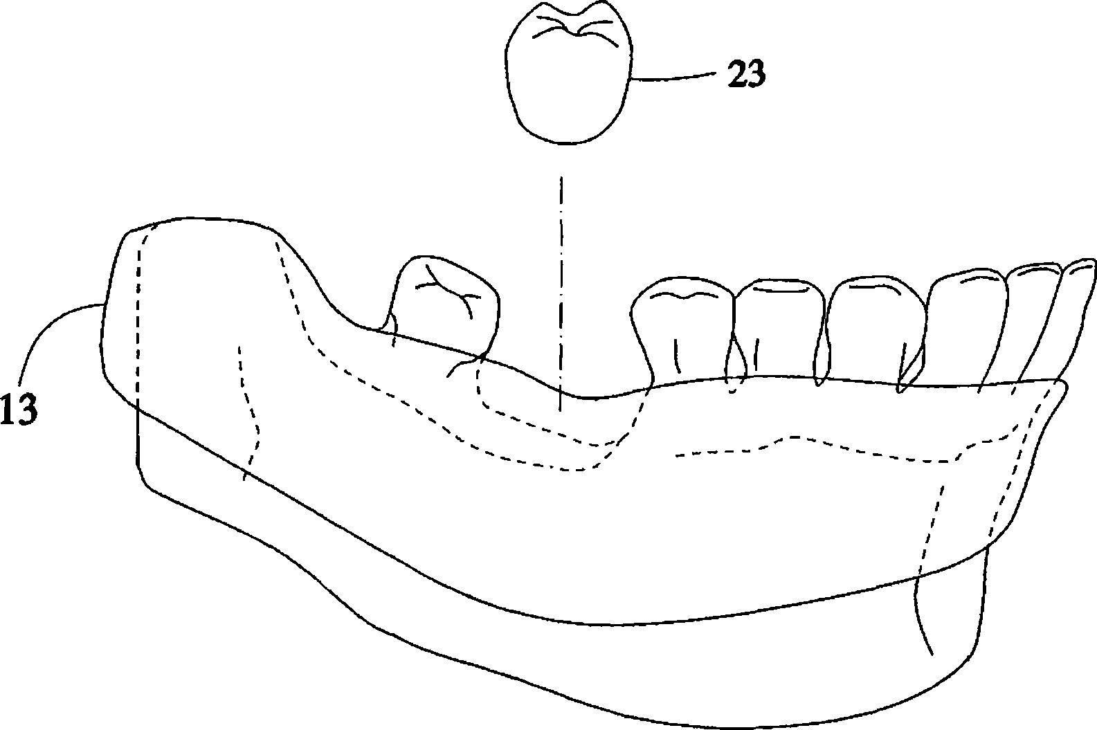 Digital supporting tooth design method by digital tooth implantation technology