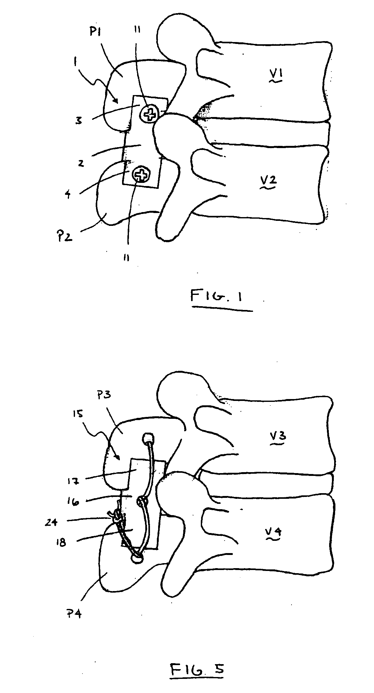 Spinal distraction device and methods of manufacture and use