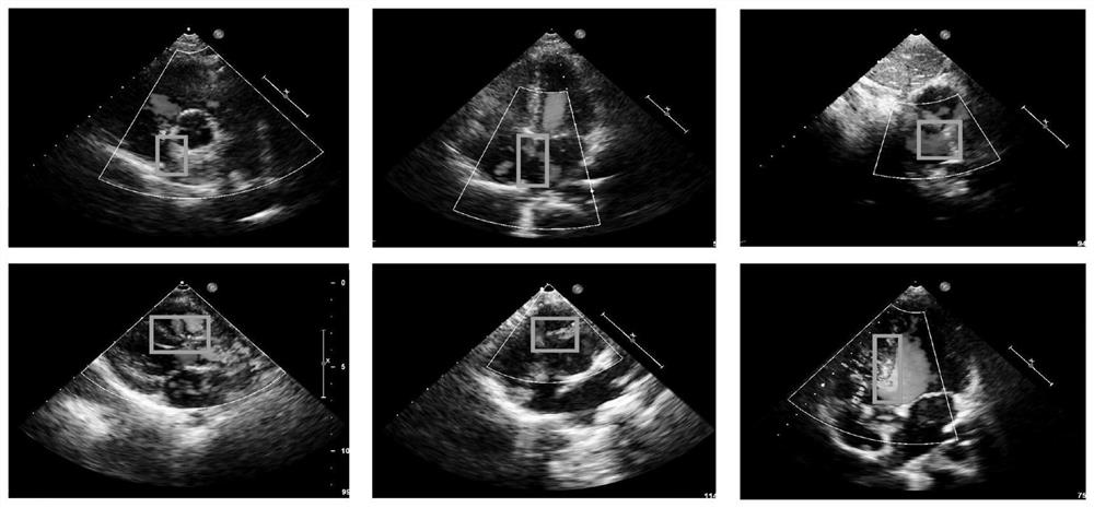 A method for auxiliary diagnosis of congenital heart disease based on multi-view collaborative relationship