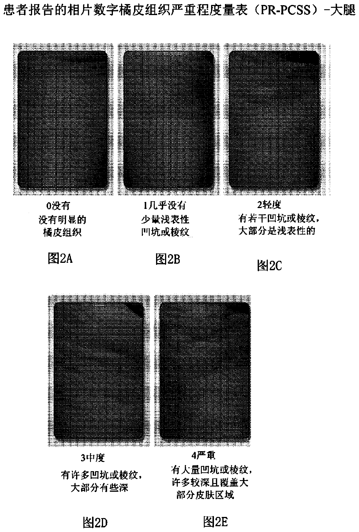 Apparatus and method for assessing and treating cellulite