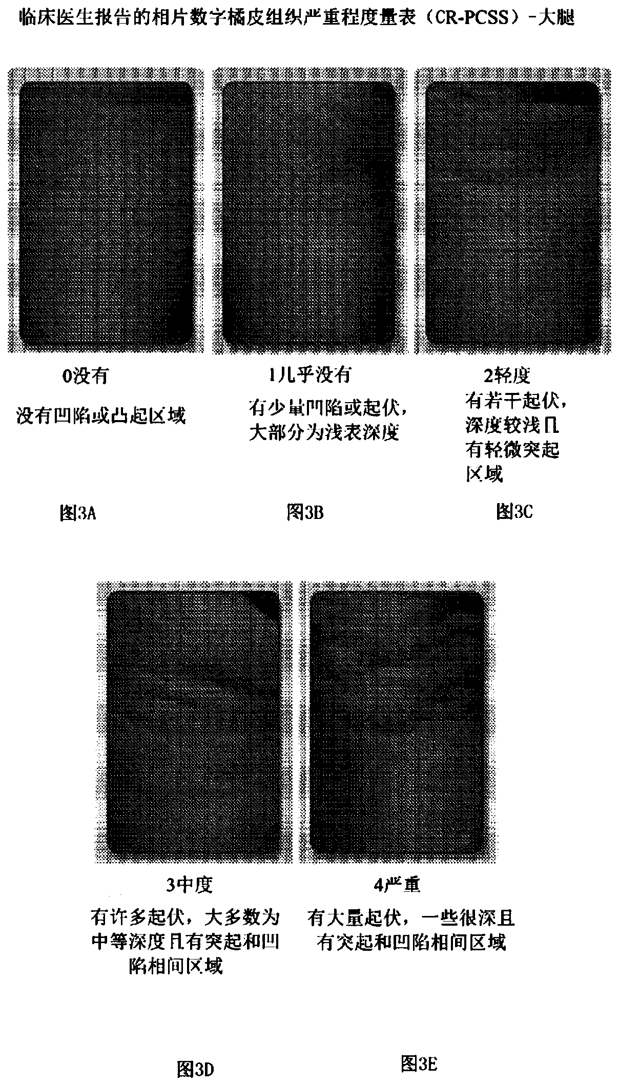 Apparatus and method for assessing and treating cellulite