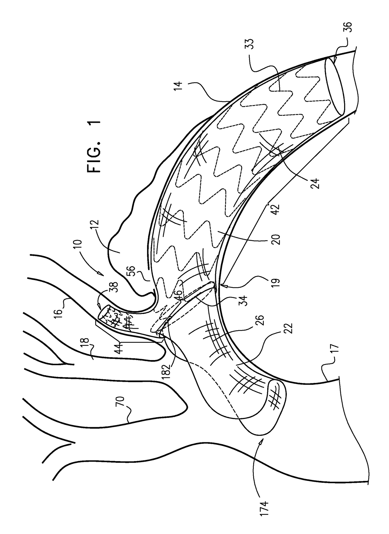 Multi-component stent-graft system for aortic dissections