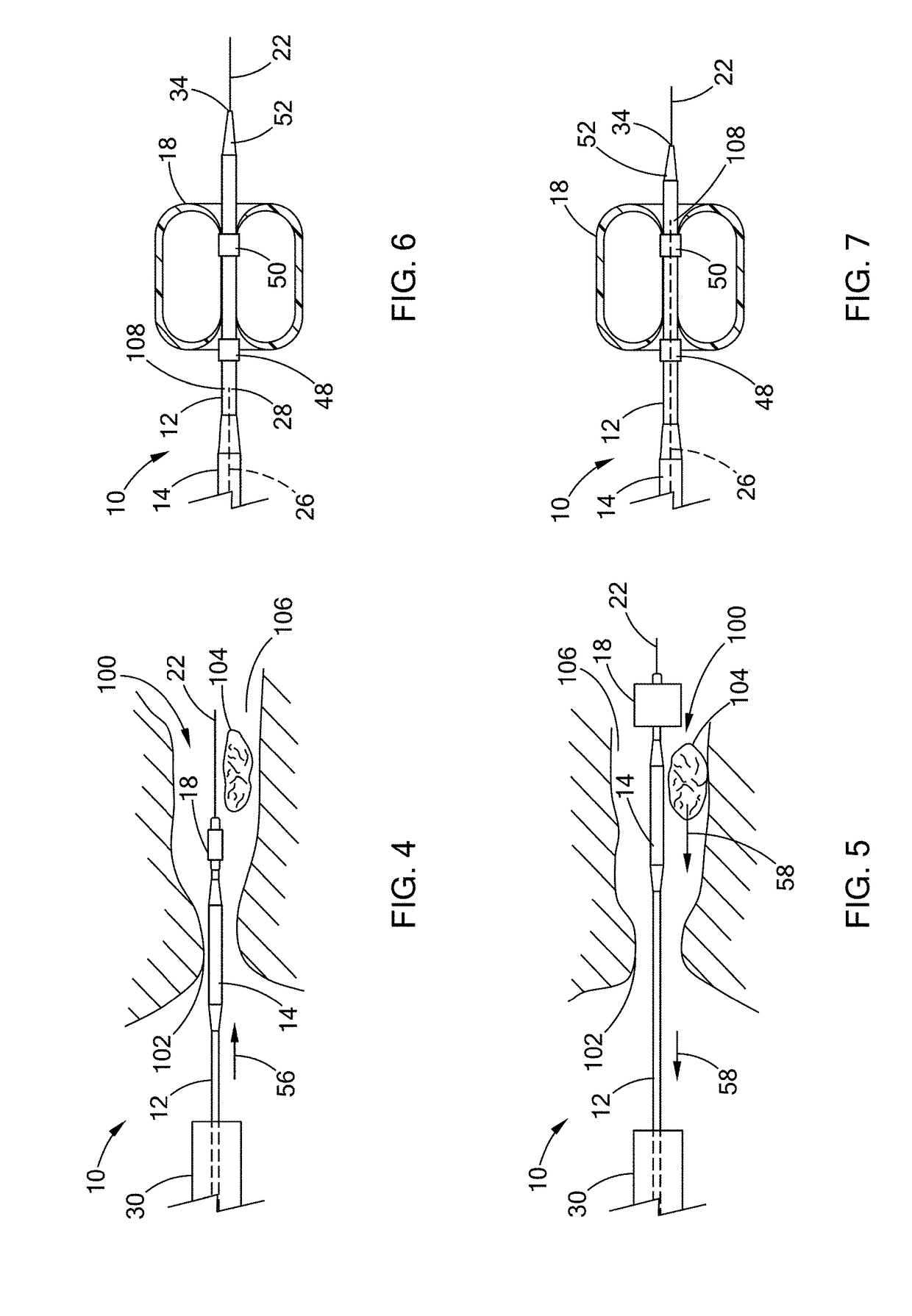 Medical devices, kits, and methods for stone extraction