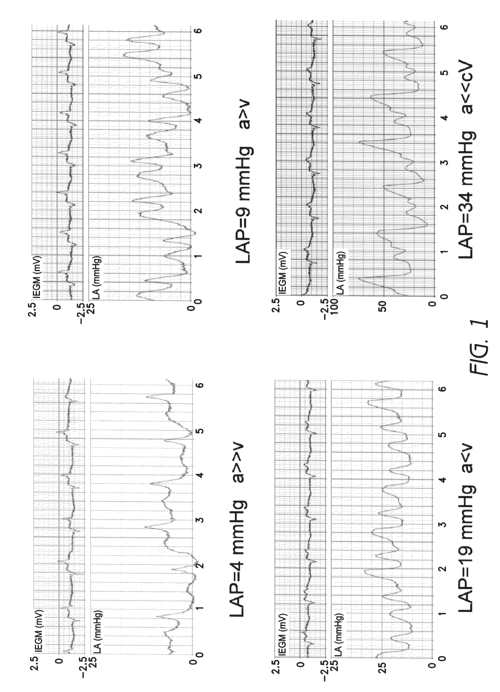 Hemodynamic waveform-based diagnosis and treatment