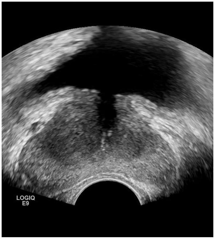 Prostate ultrasonic image segmentation and classification method