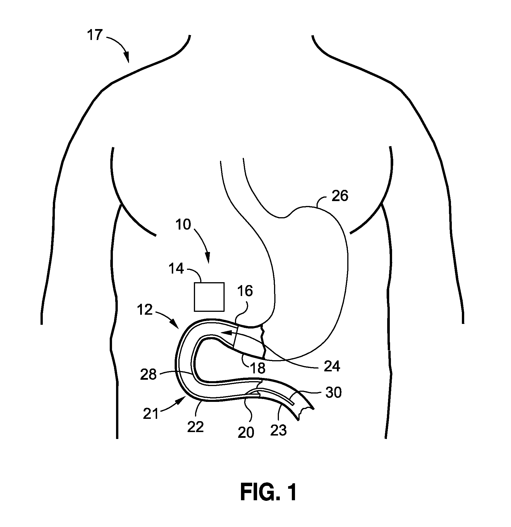 Intraluminal sleeve with active agents