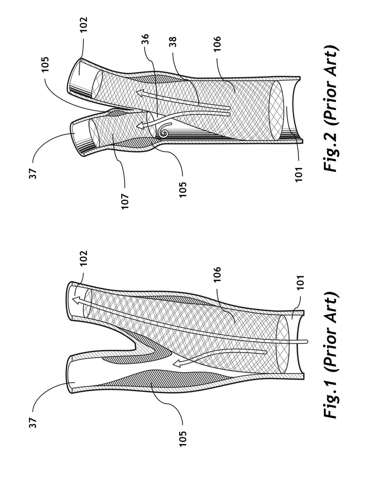 Bifurcated 3D filter assembly for prevention of stroke