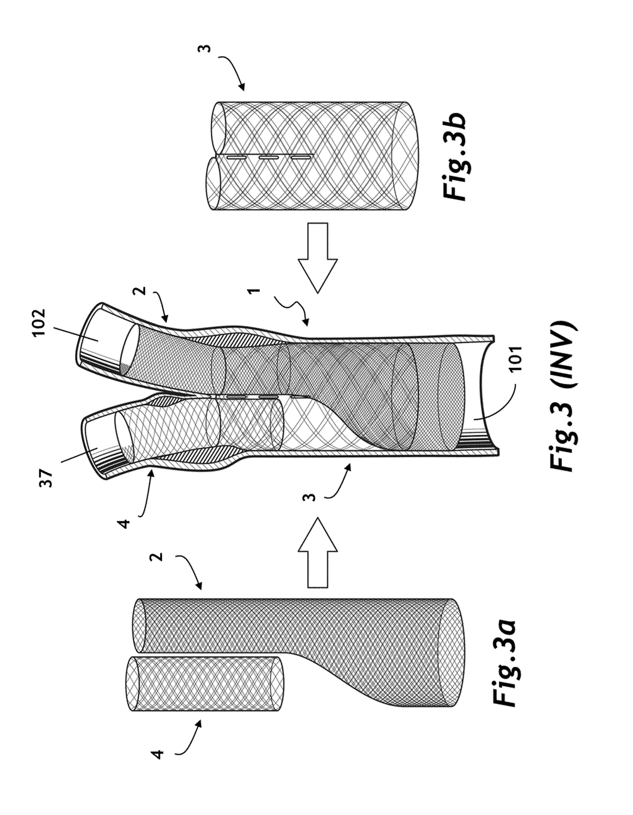 Bifurcated 3D filter assembly for prevention of stroke