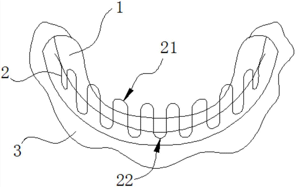 Tooth protrusion appliance - Eureka | Patsnap develop intelligence library