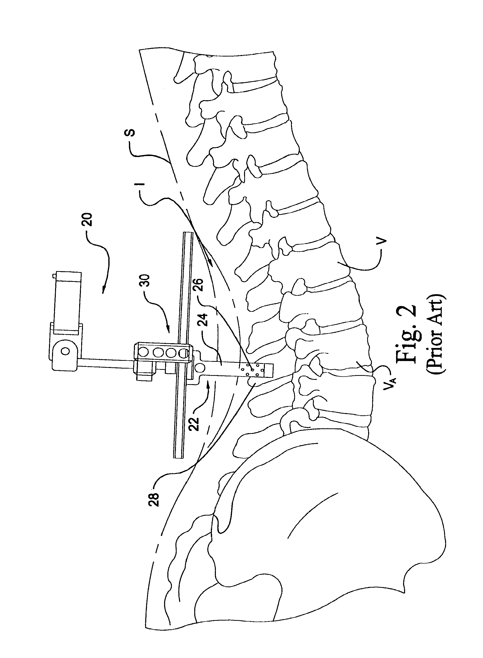 Instrumentation and method for mounting a surgical navigation reference device to a patient