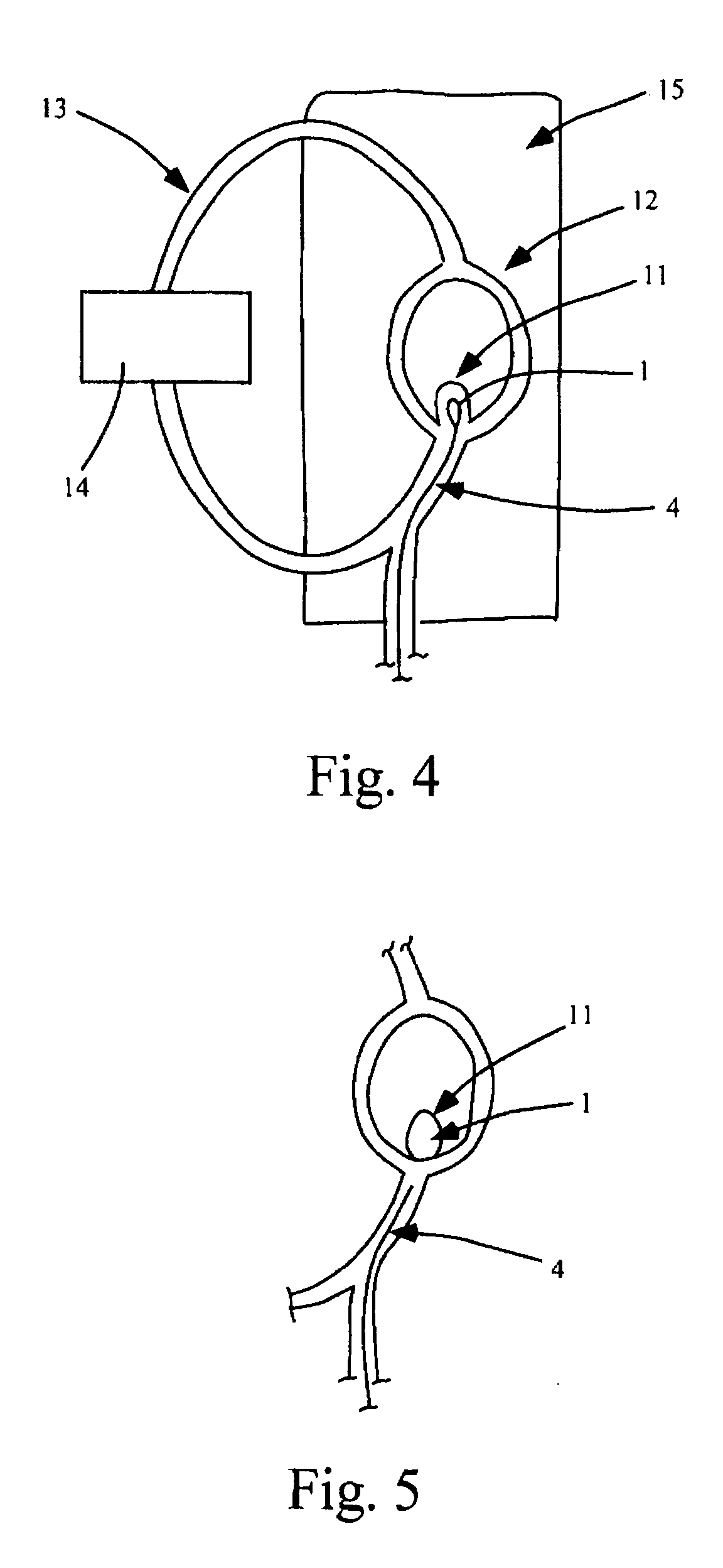 Aneurysm treatment using semi-compliant balloon