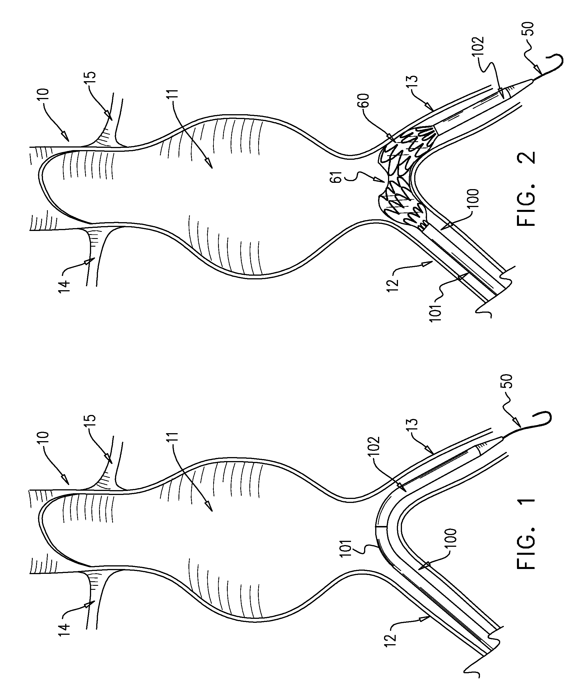 Multi-component expandable supportive bifurcated endoluminal grafts and methods for using same