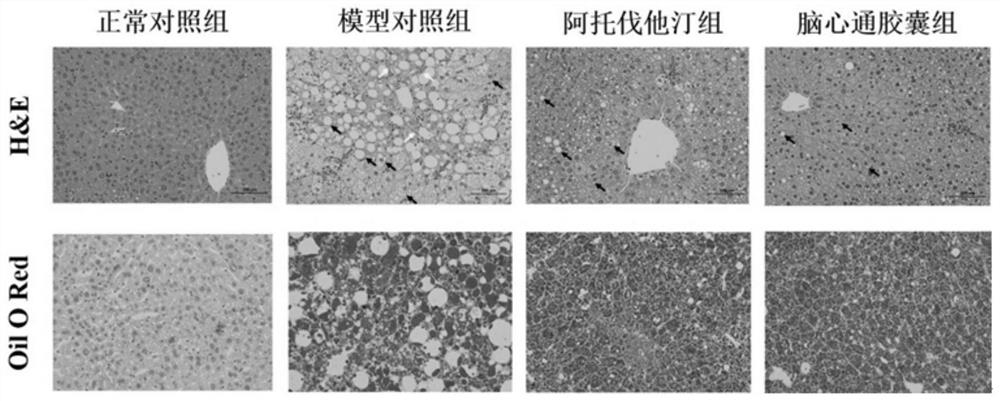 Application of Naoxintong preparation in preparation of medicine for treating non-alcoholic fatty liver disease