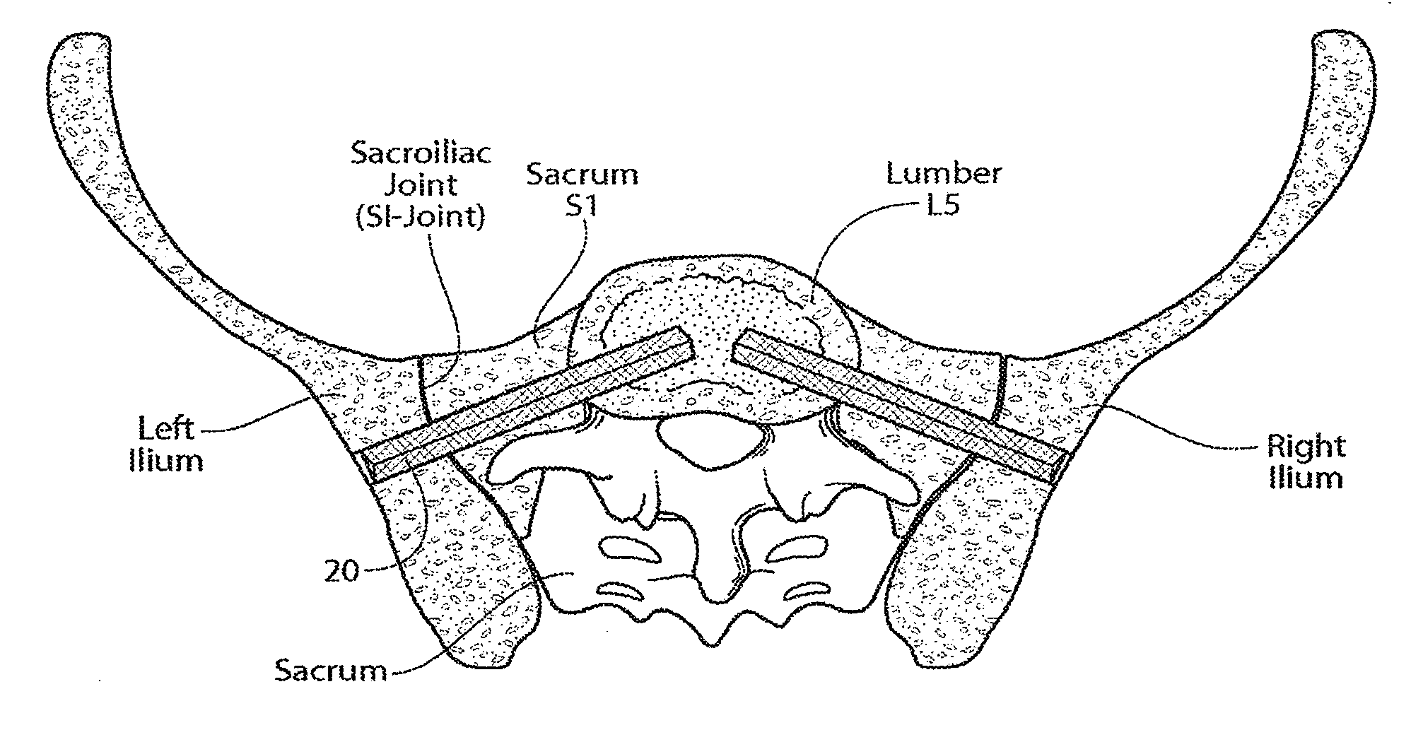 Apparatus, systems and methods for achieving anterior lumbar interbody fusion