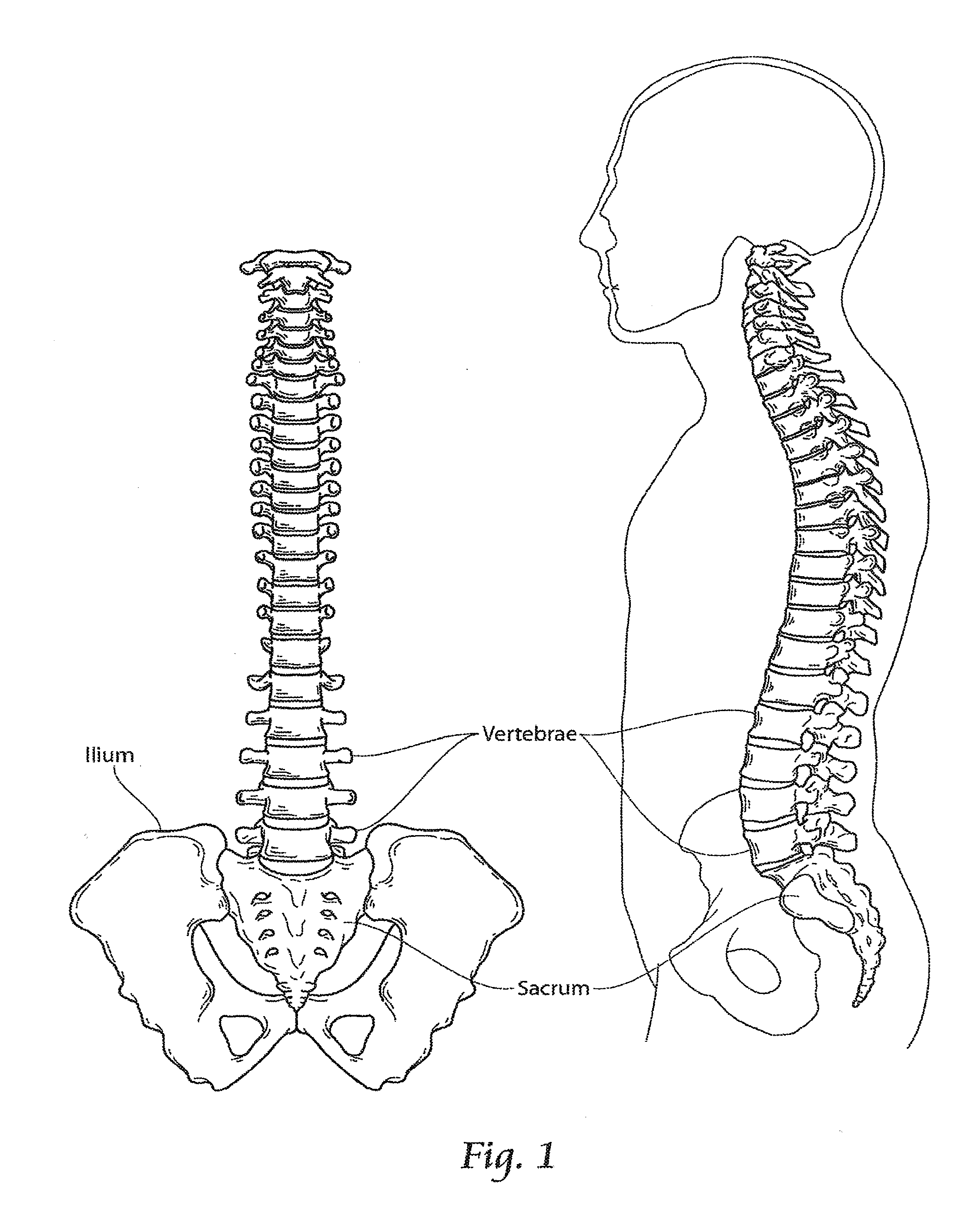 Apparatus, systems and methods for achieving anterior lumbar interbody fusion