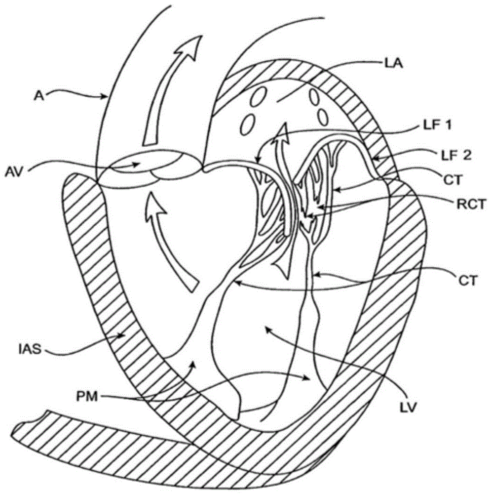 sequentially deployed transcatheter mitral valve prosthesis