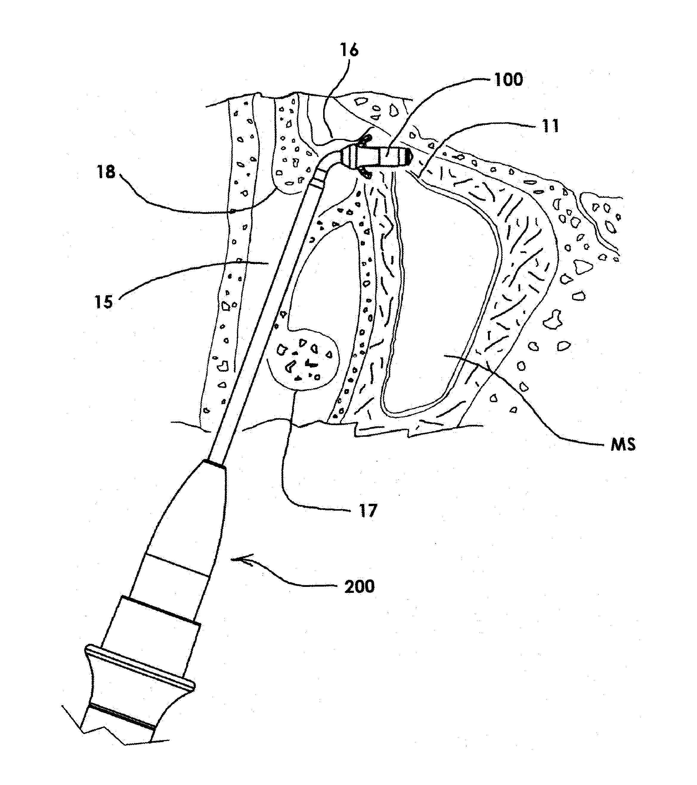 Devices and Methods for Dilating a Paranasal Sinus Opening and for Treating Sinusitis