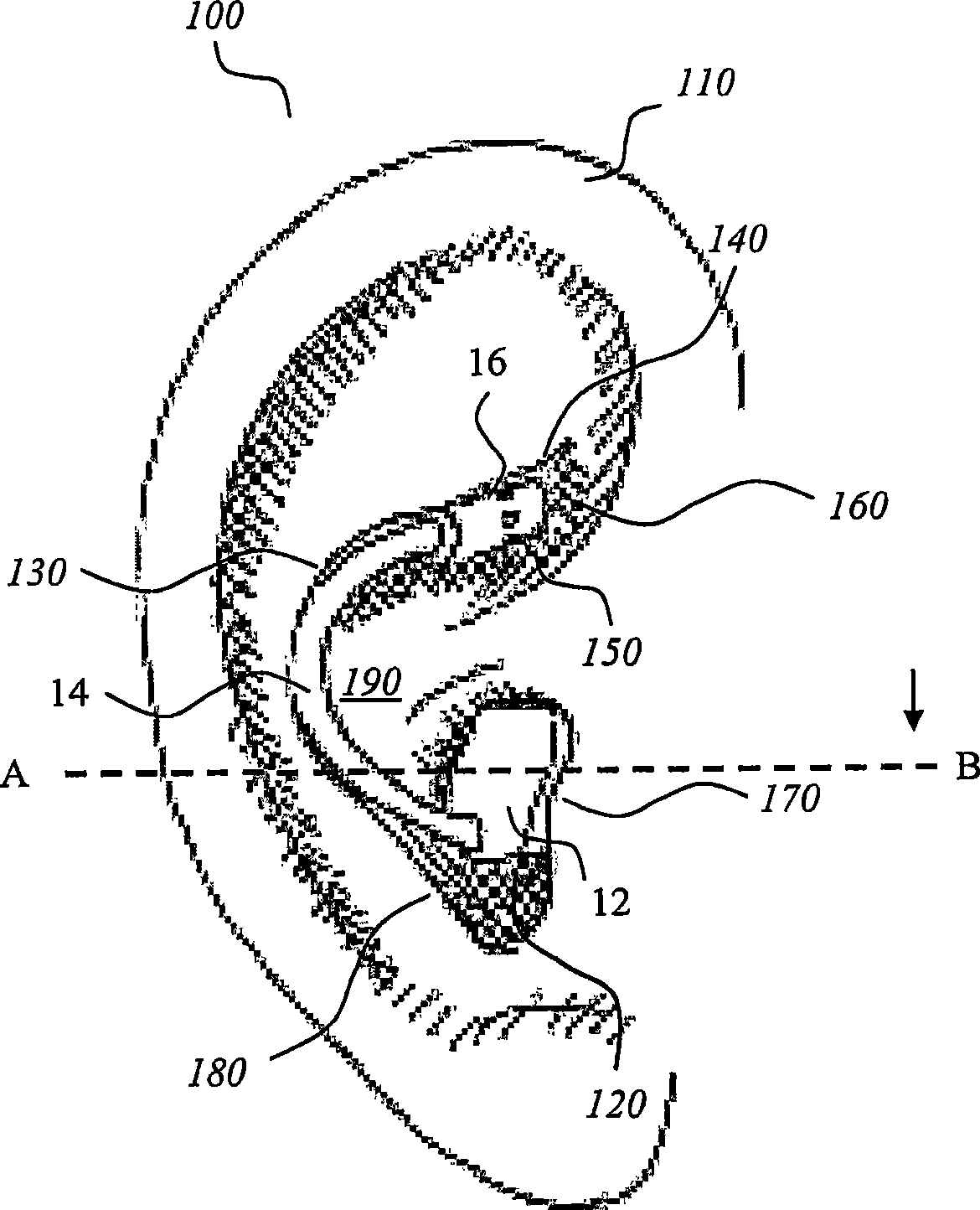 A hearing aid with a removably connected elongate member