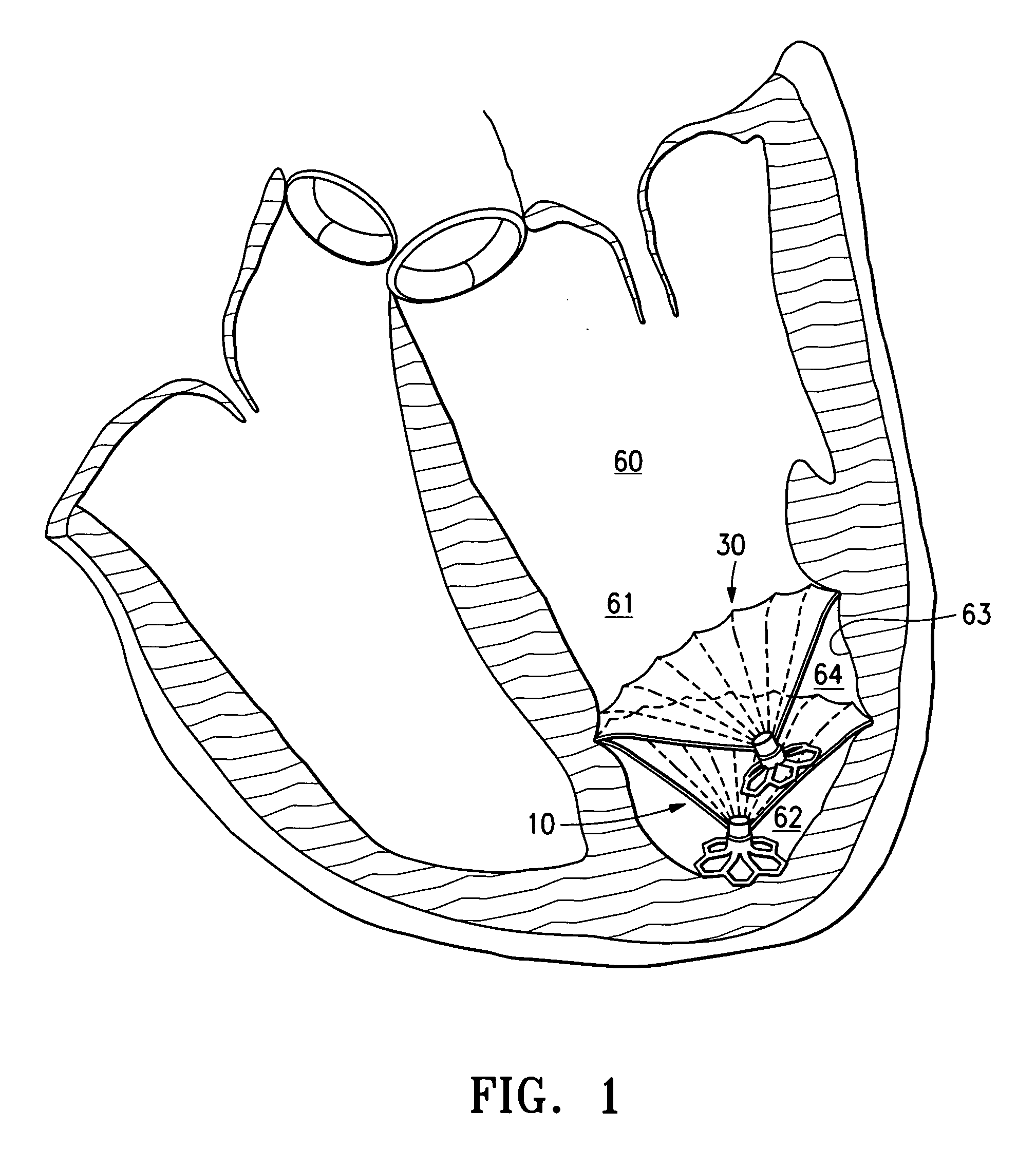 Multiple partitioning devices for heart treatment