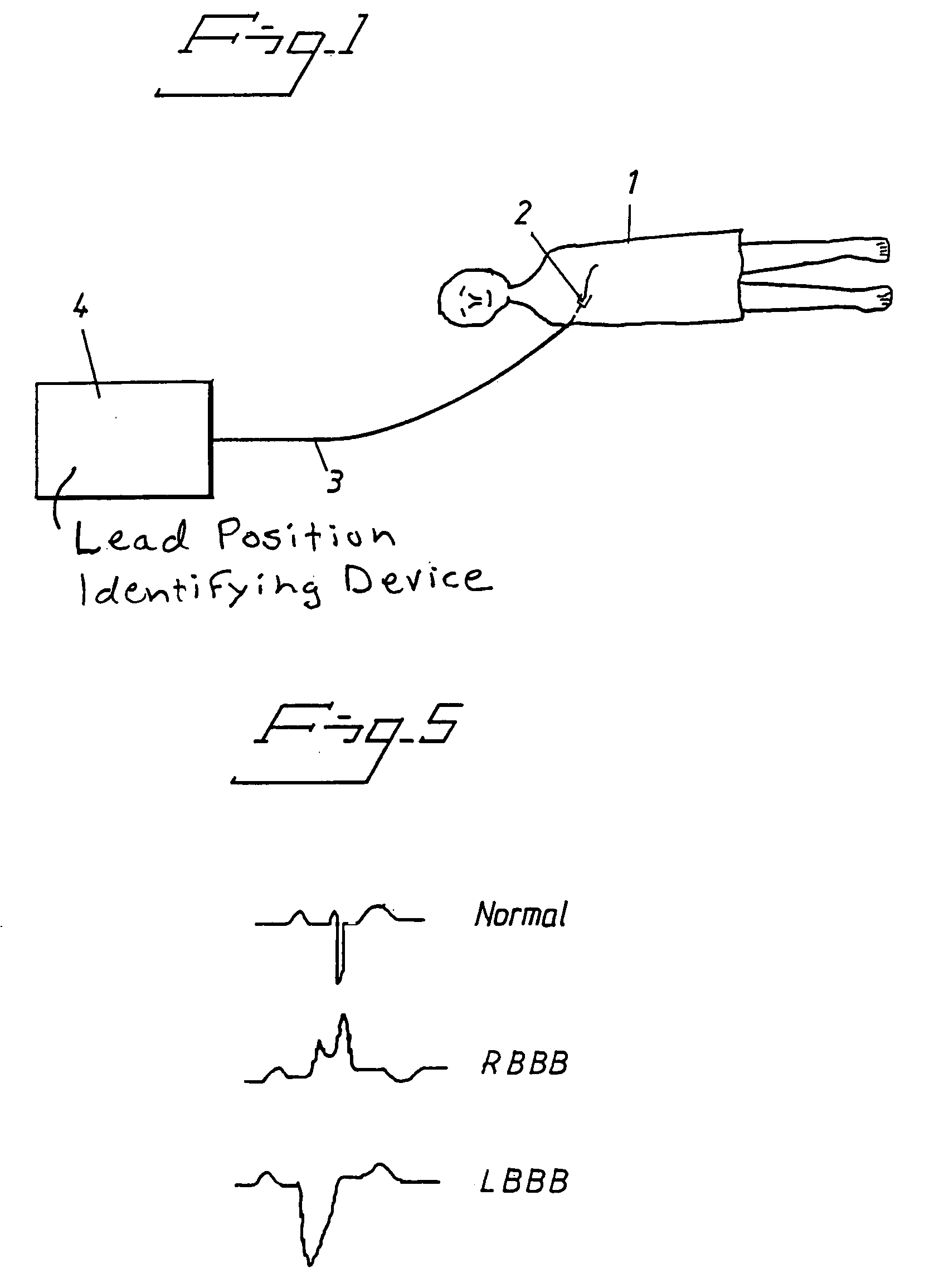 Arrangement and Method for Evaluating Operational Effectiveness of Implantable Medical Electrode Leads for Different Lead Placements