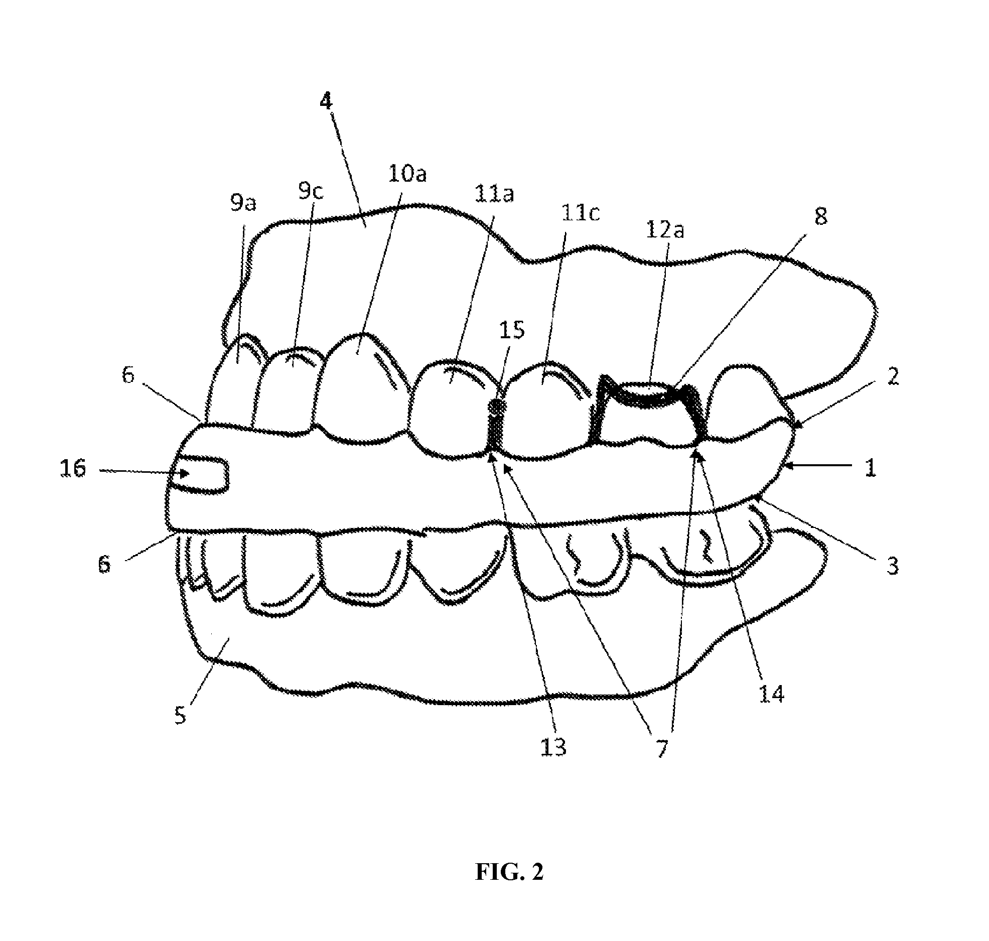 Intraoral functional device for relieving obstructive sleep apnea syndrom, snoring and/or other airway disorders
