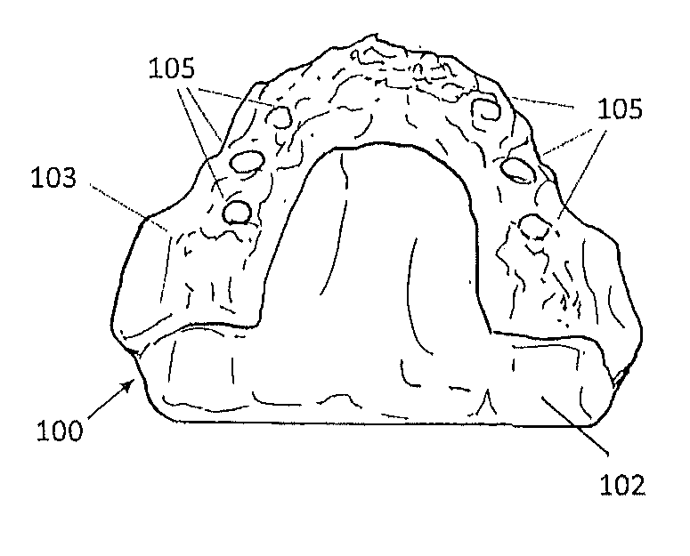 Method of using an endentulous surgical guide