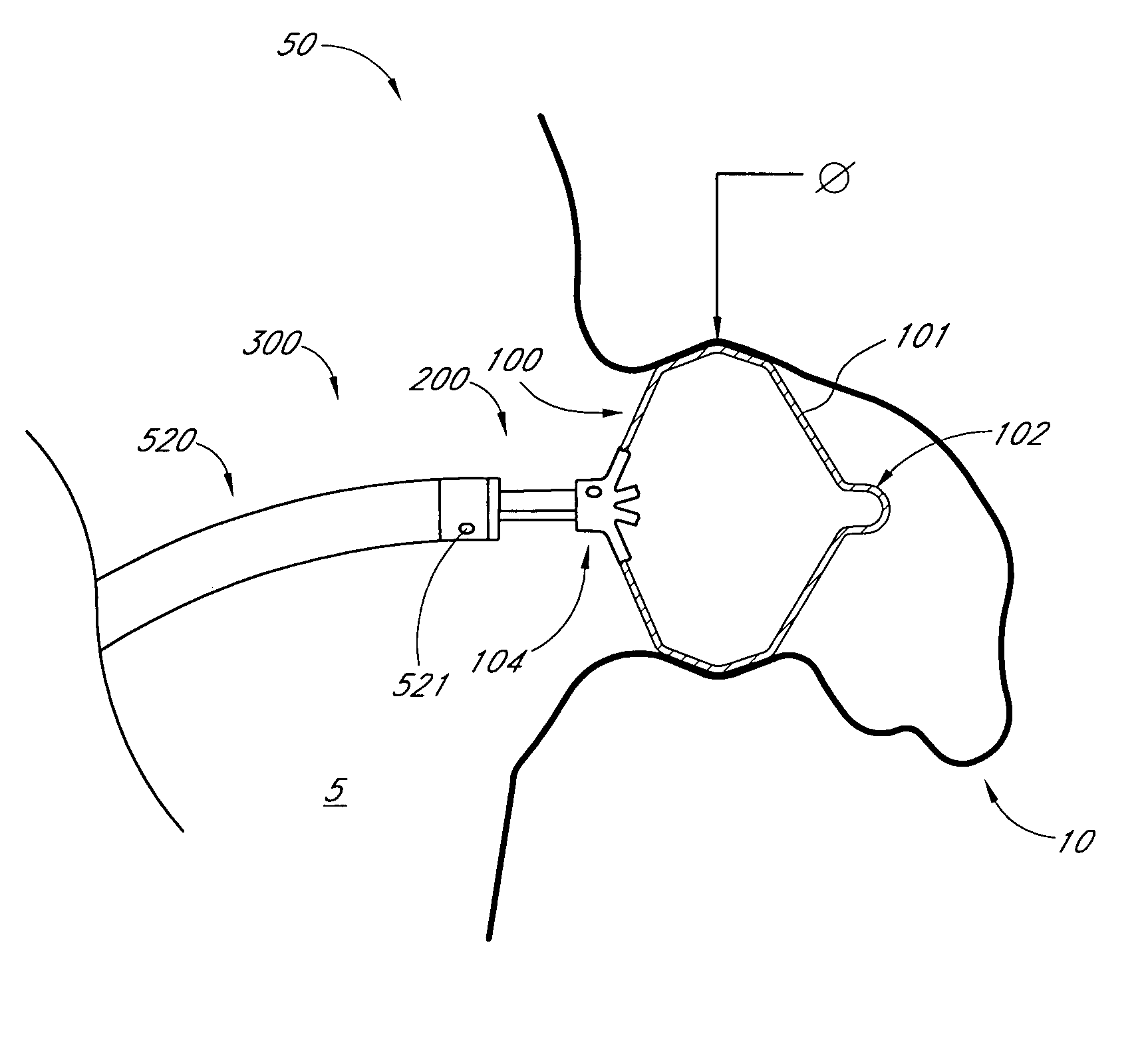Method and apparatus for delivering an implant without bias to a left atrial appendage