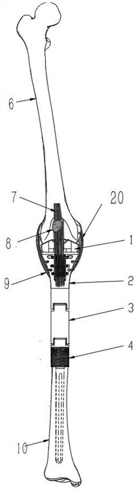 A Modular Half Knee Prosthesis for Ligament-preserving Tibia Tumor