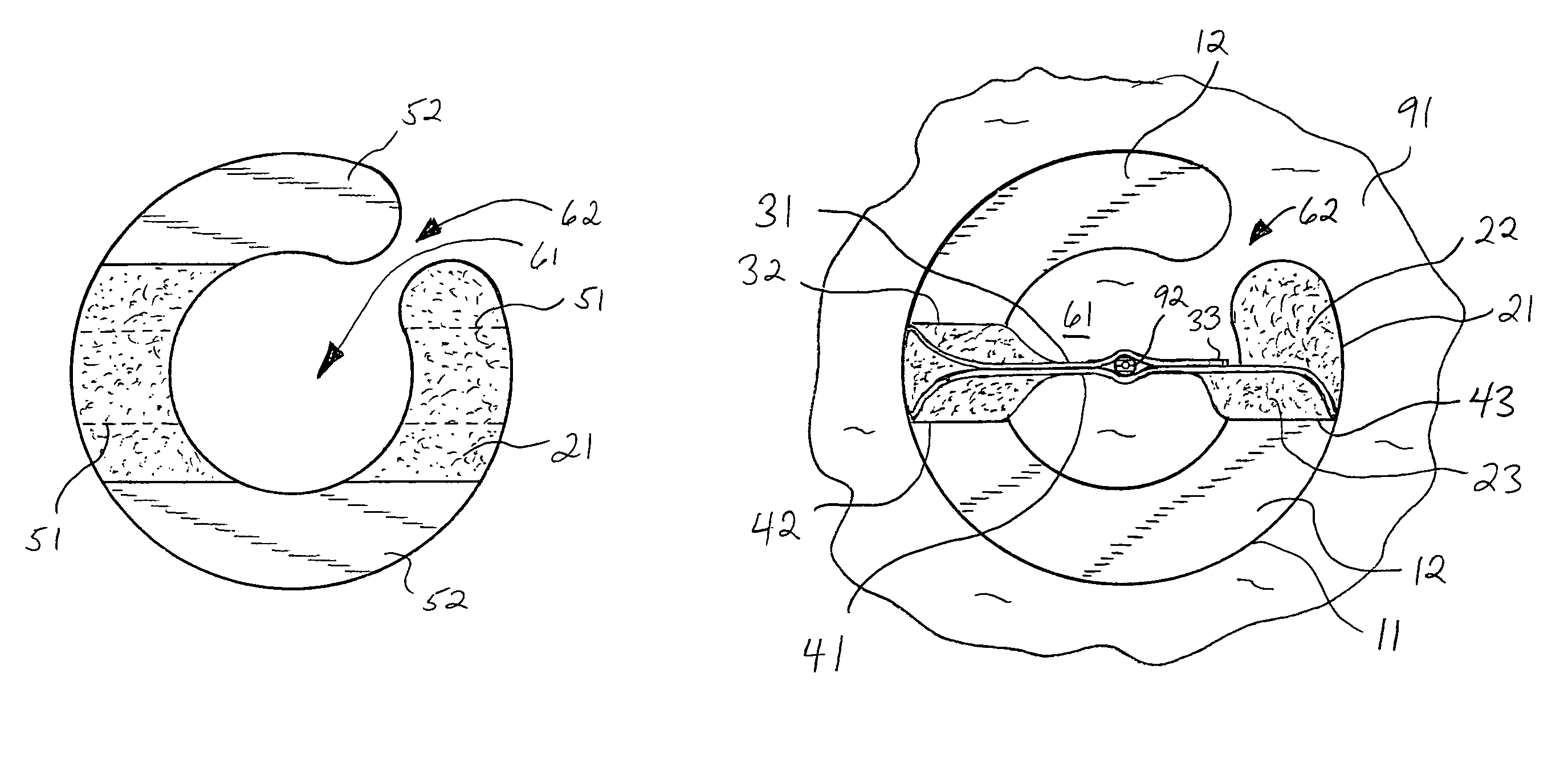 Slotted catheter securement device