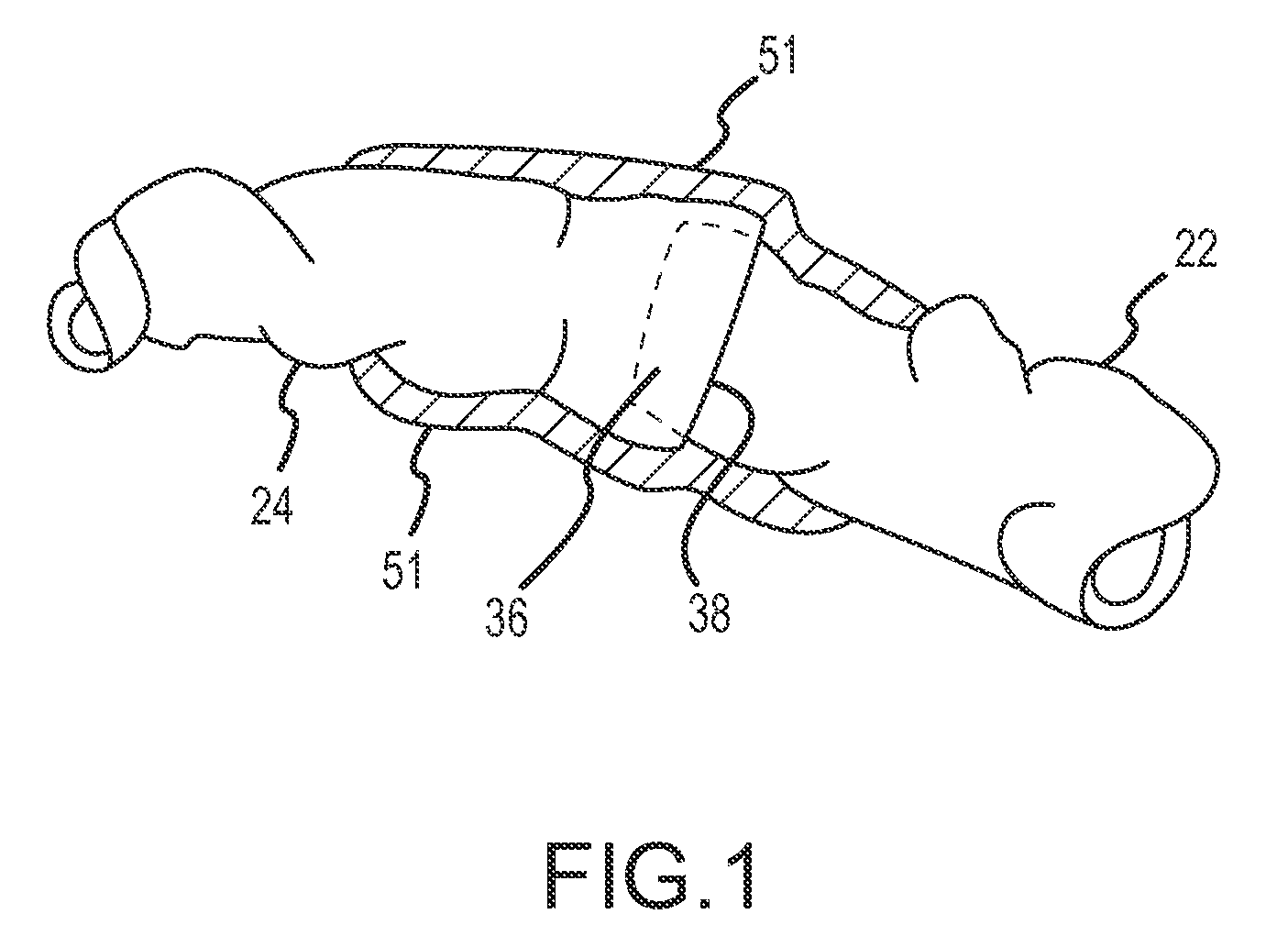 Methods and apparatus for surgical anastomosis