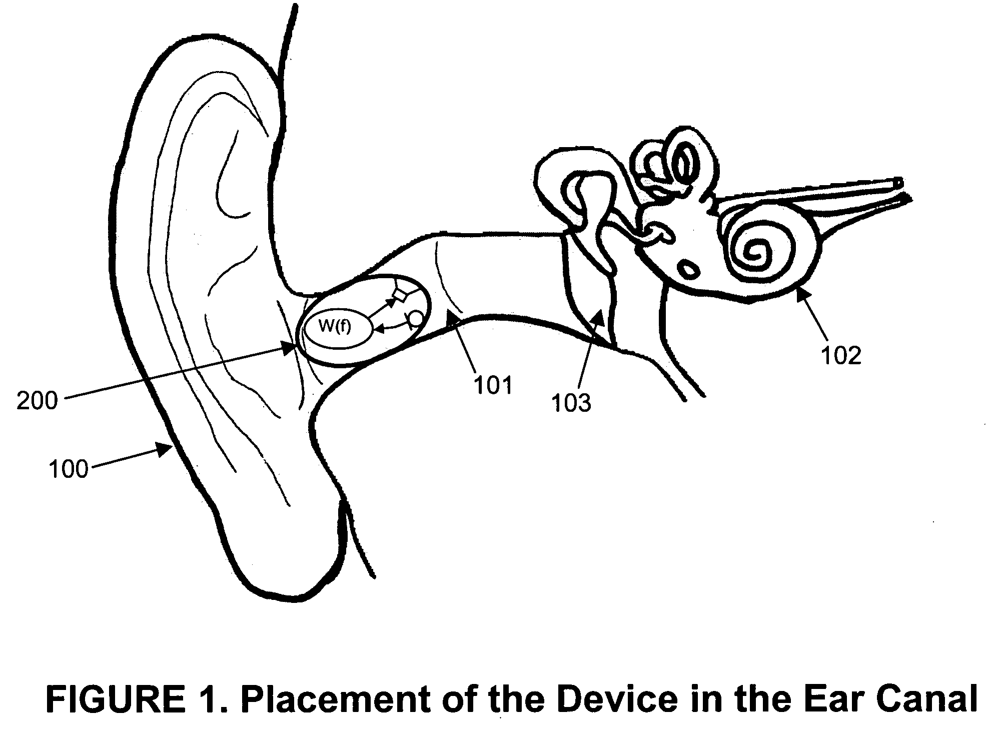 Suppression of tinnitus