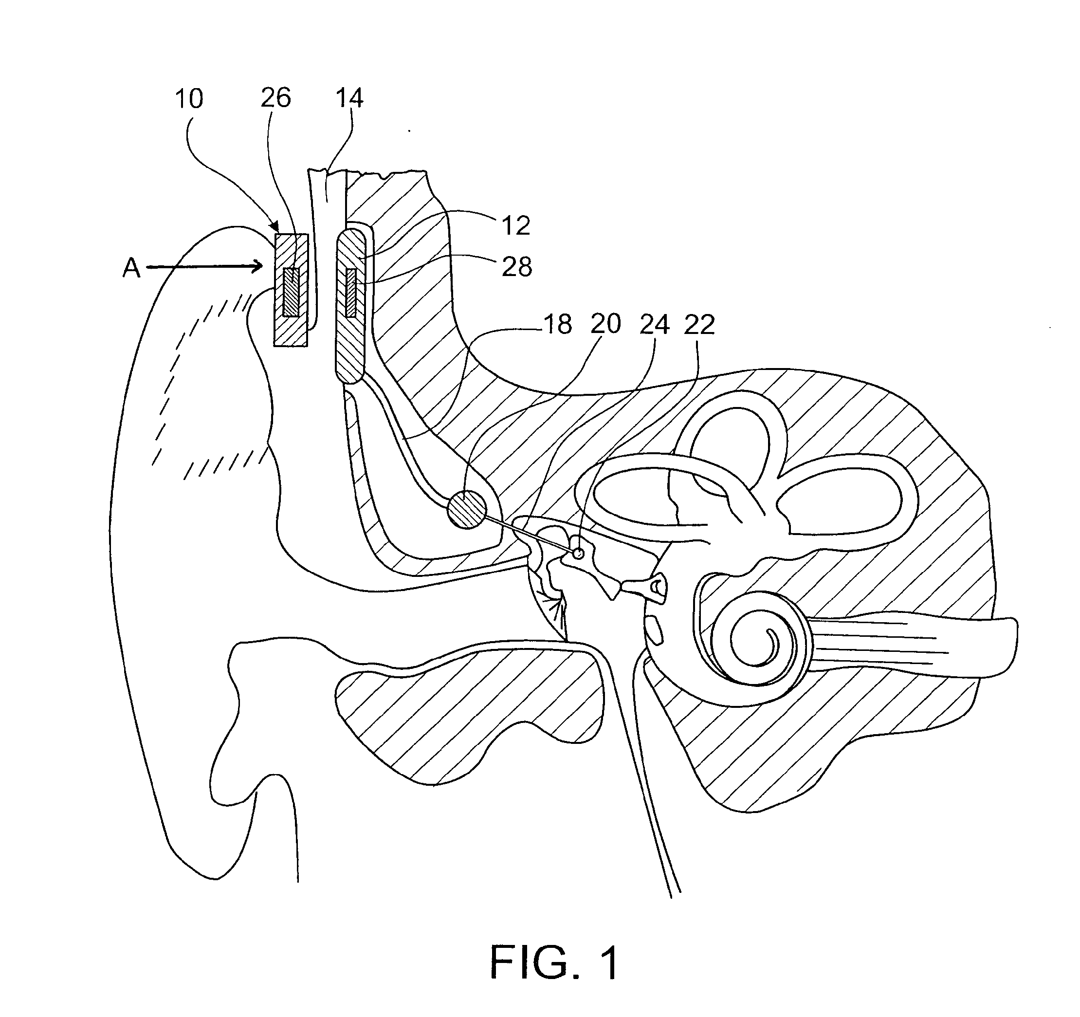 Rechargeable partially implantable hearing instrument