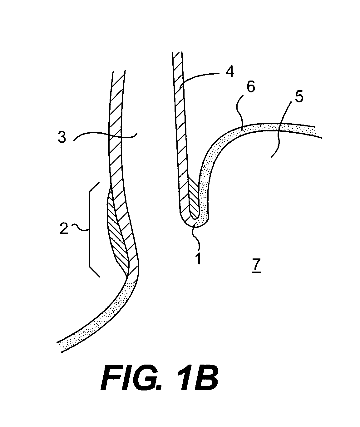 Endoscopic fundoplication devices and methods for treatment of gastroesophageal reflux disease