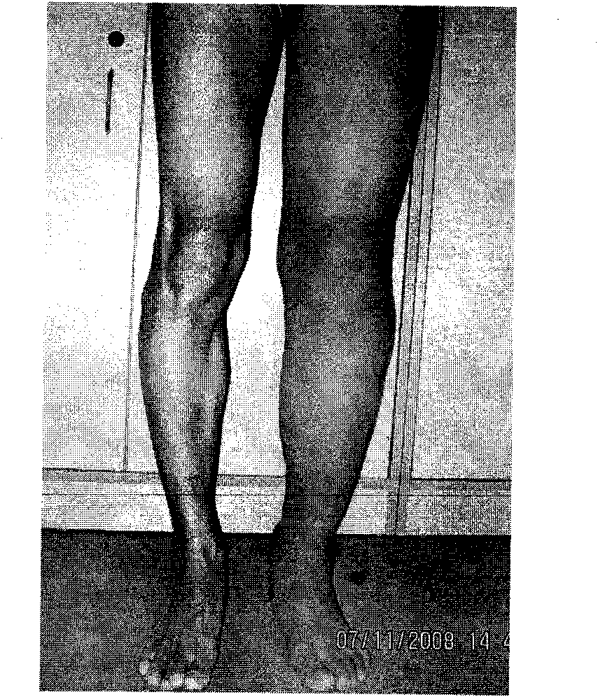 Medicament for treating edema of limbs and trunks and application thereof