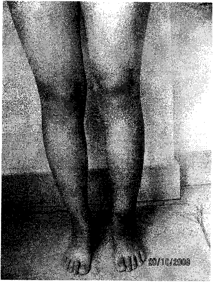 Medicament for treating edema of limbs and trunks and application thereof