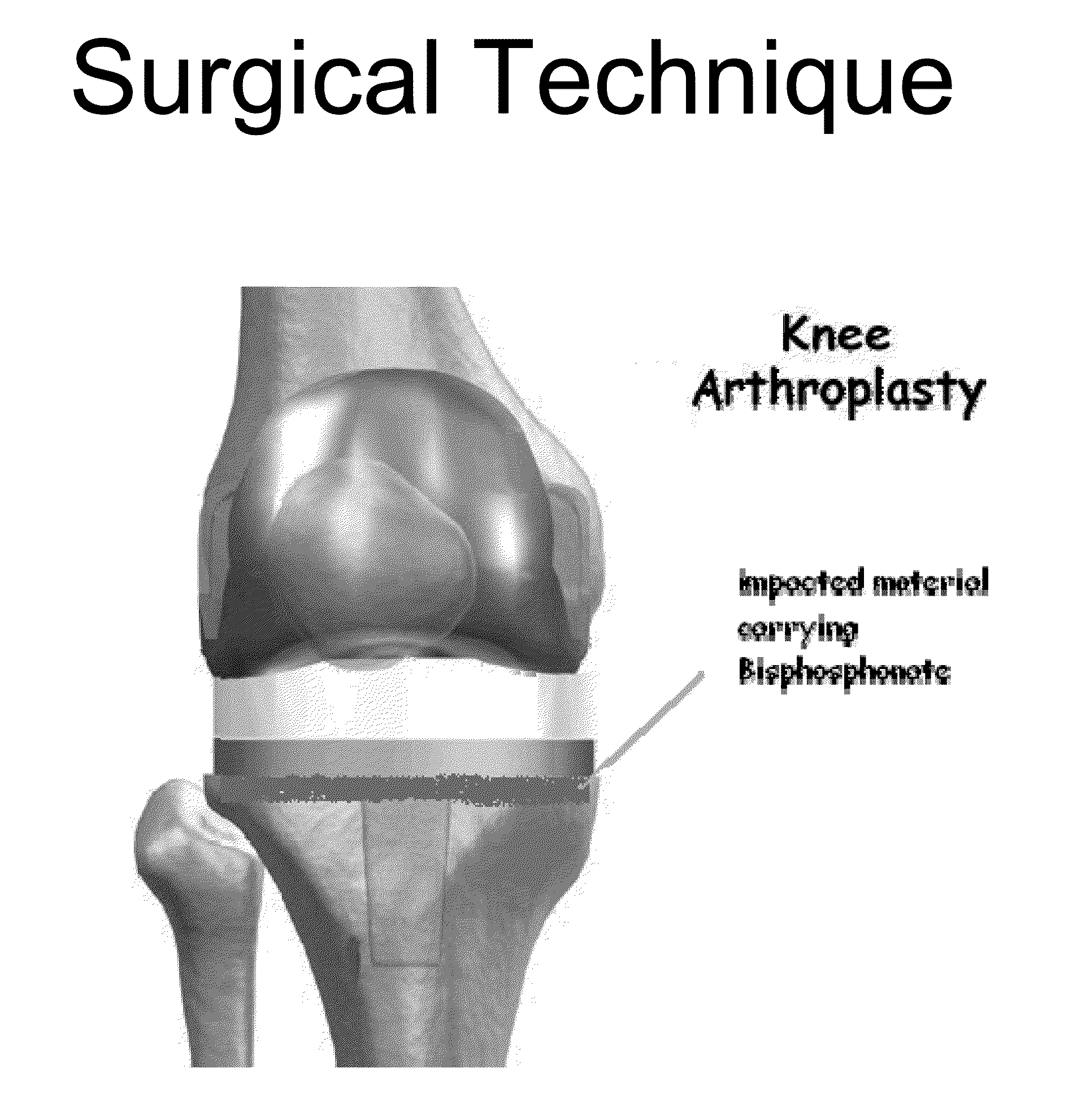 Method of delivering a biphosphonate and/or strontium ranelate below the surface of a bone