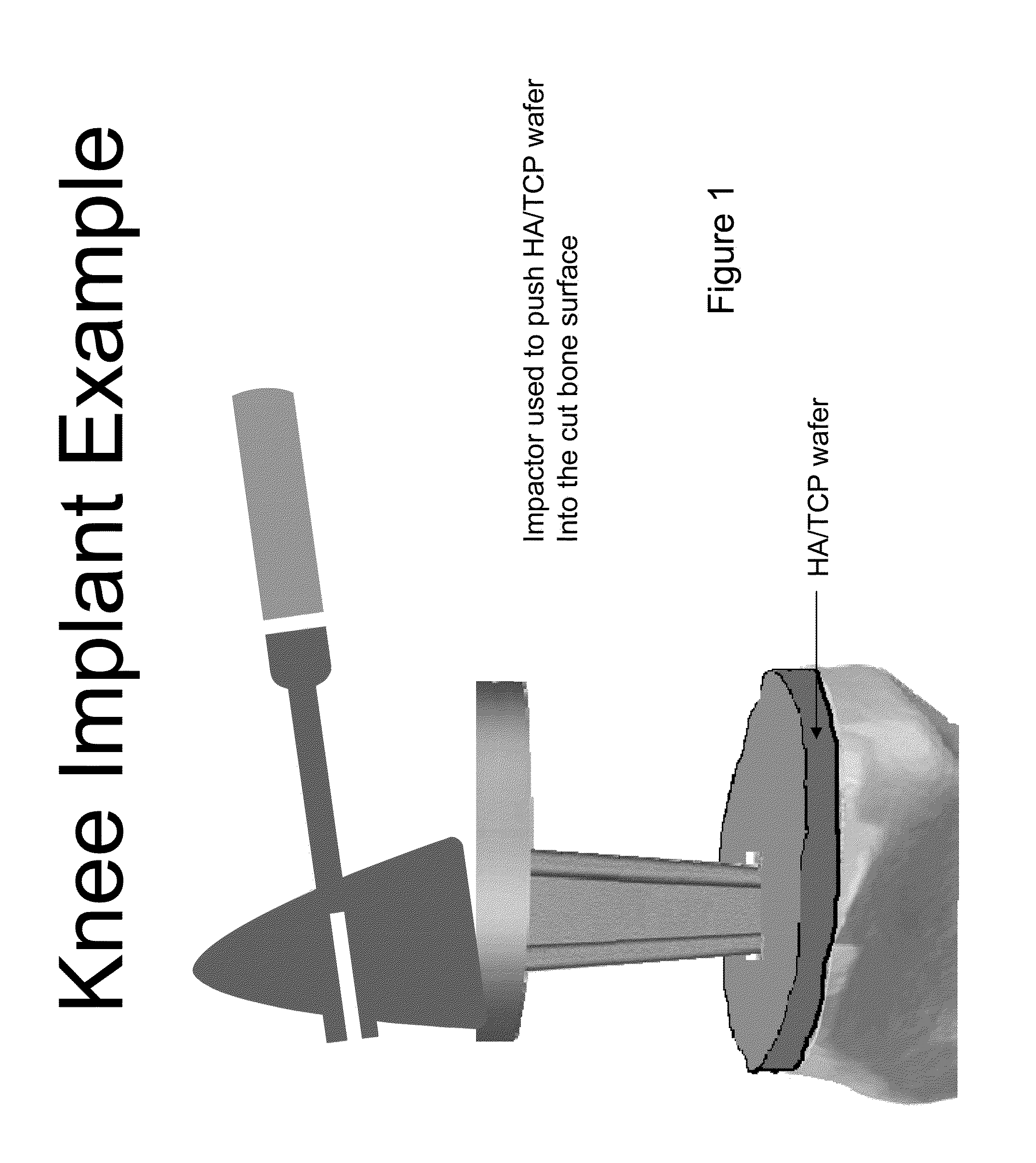 Method of delivering a biphosphonate and/or strontium ranelate below the surface of a bone