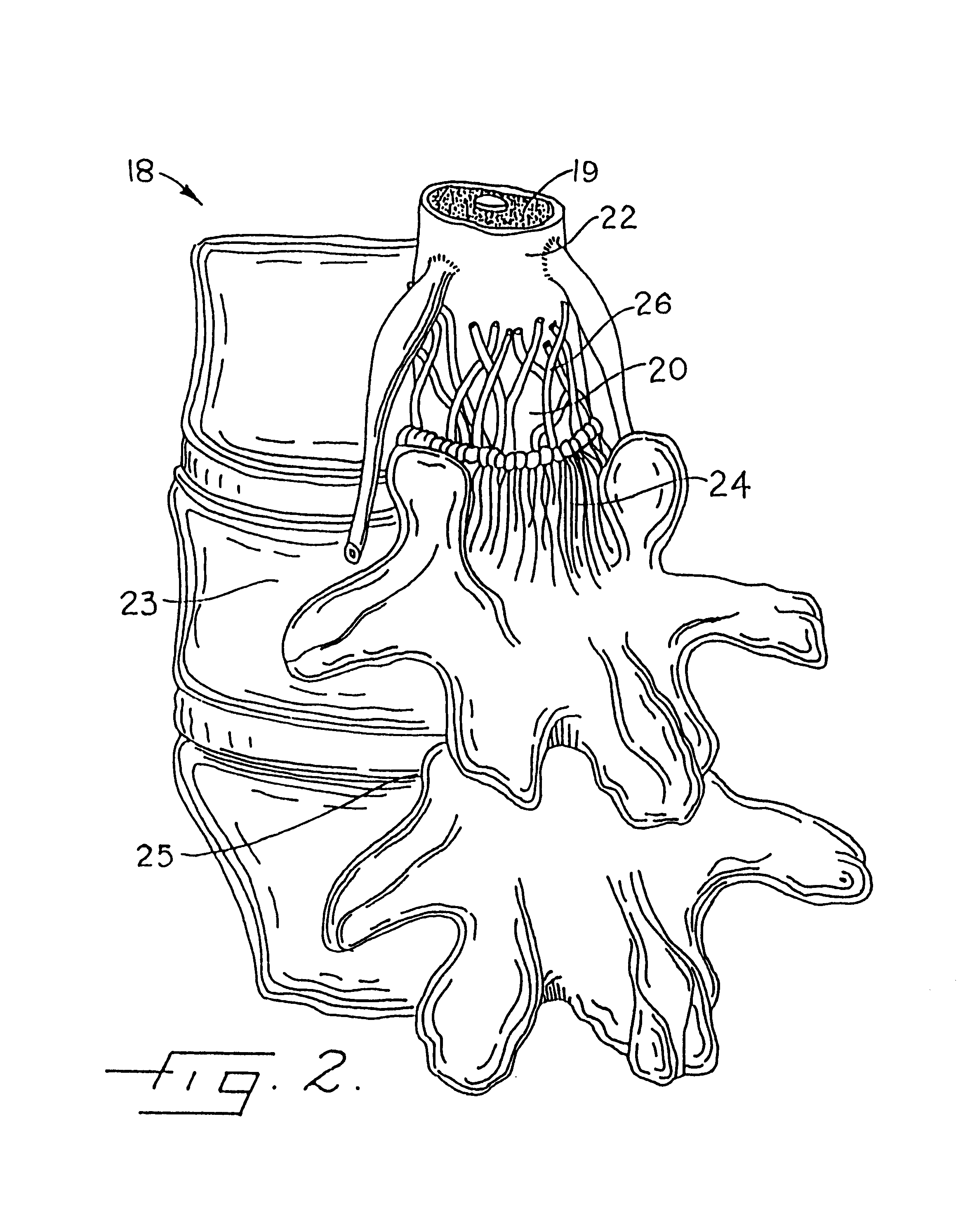 System for enhancing visibility in the epidural space