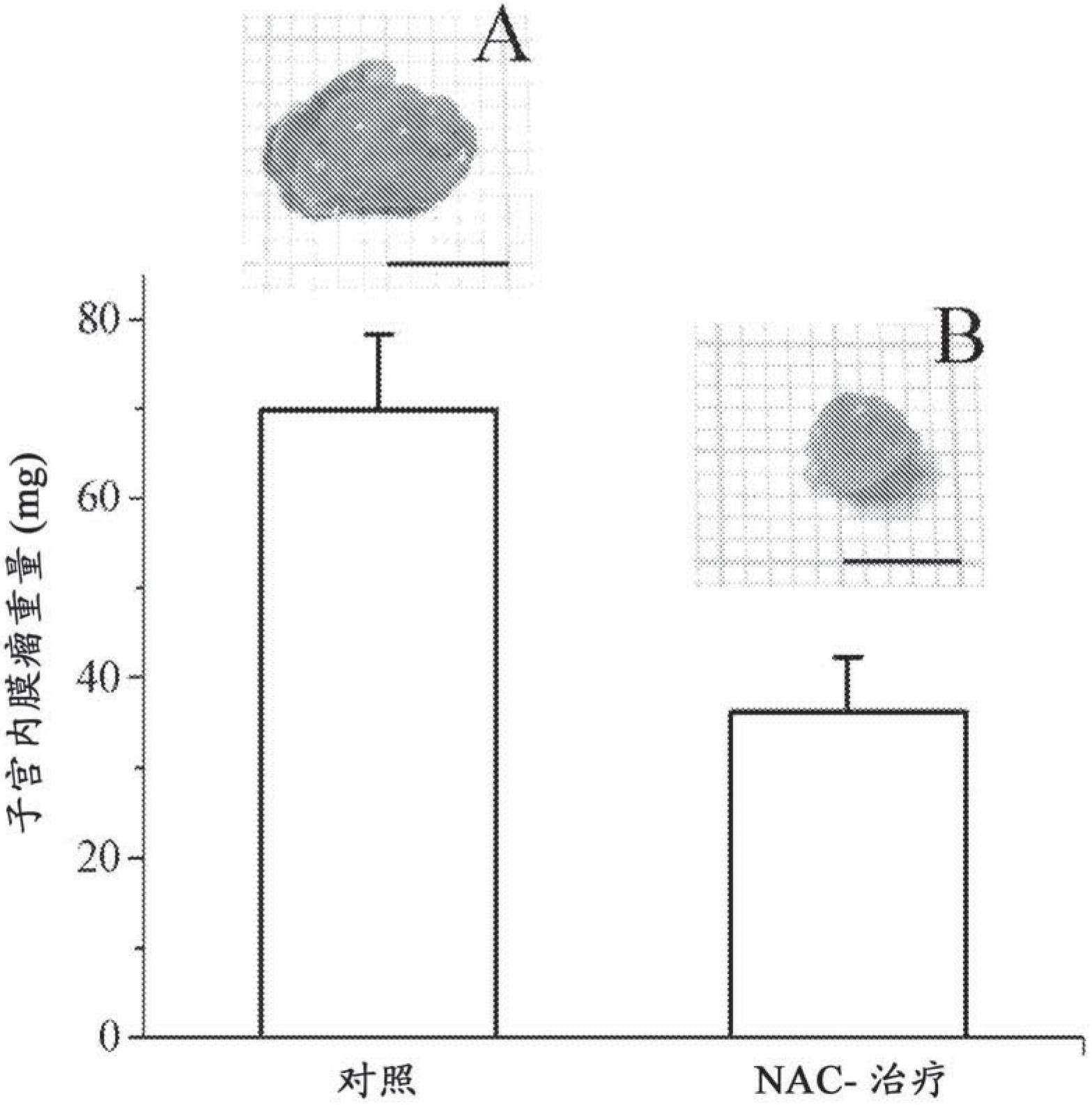 N-acetyl-l-cysteine for the treatment of endometriosis