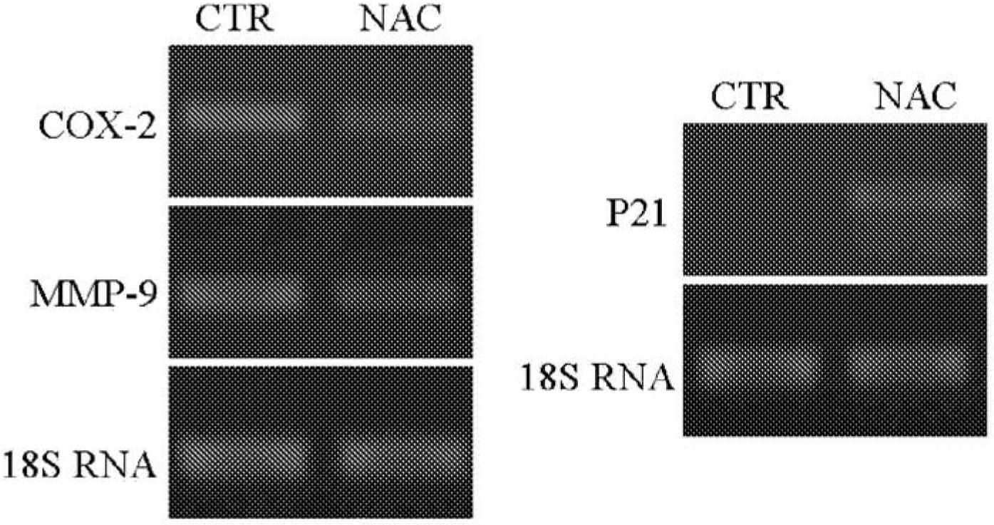 N-acetyl-l-cysteine for the treatment of endometriosis