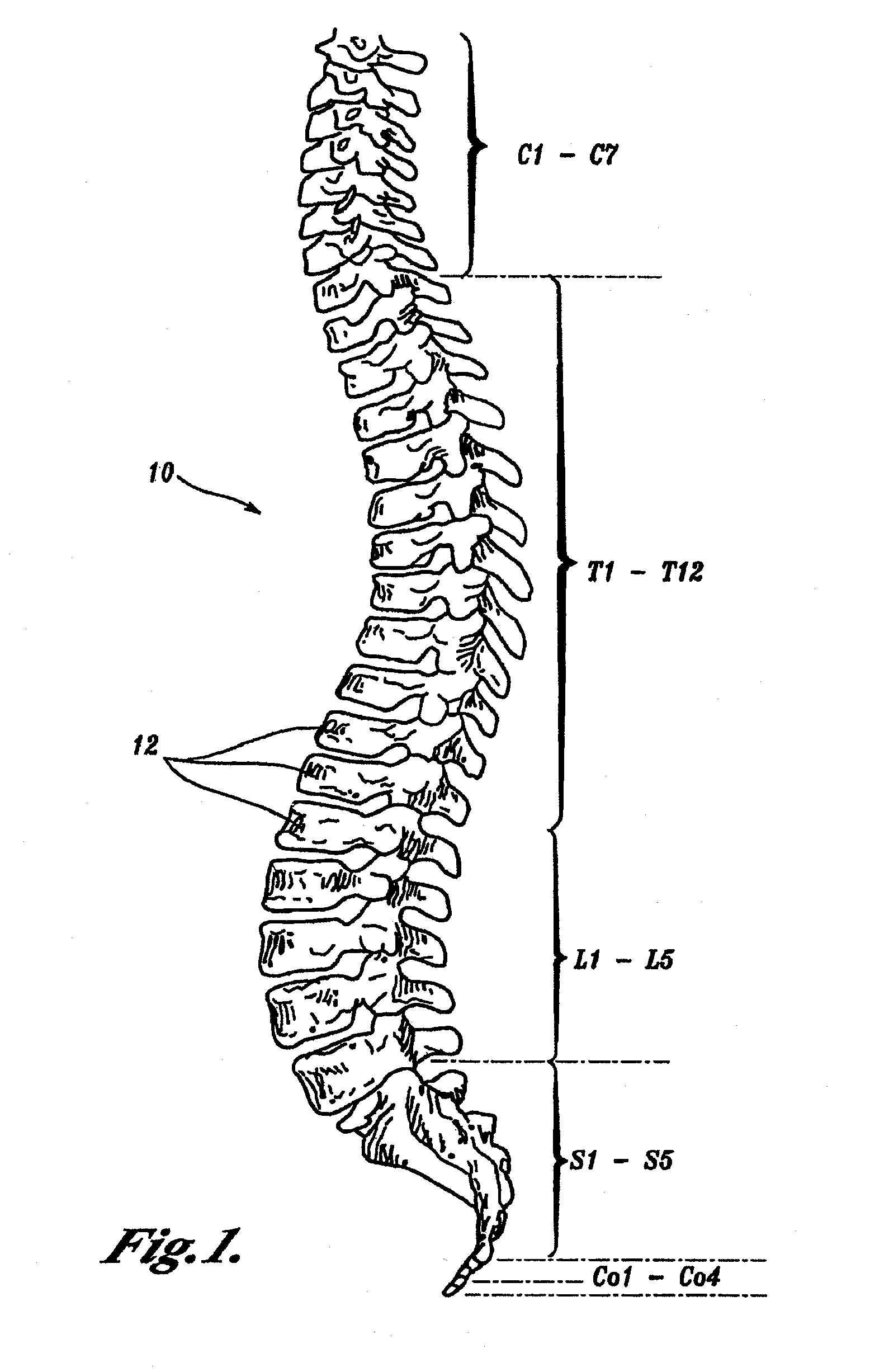 Prostheses, Tools and Methods for Replacement of Natural Facet Joints With Artificial Facet Joint Surfaces