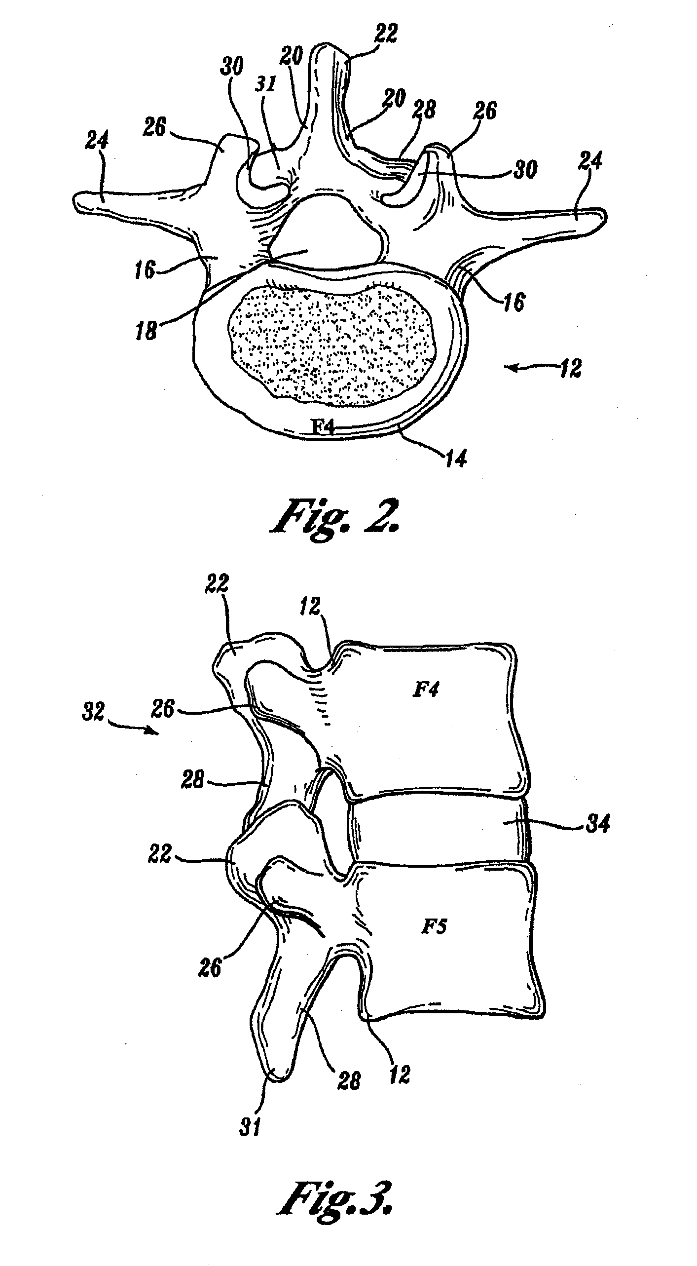 Prostheses, Tools and Methods for Replacement of Natural Facet Joints With Artificial Facet Joint Surfaces