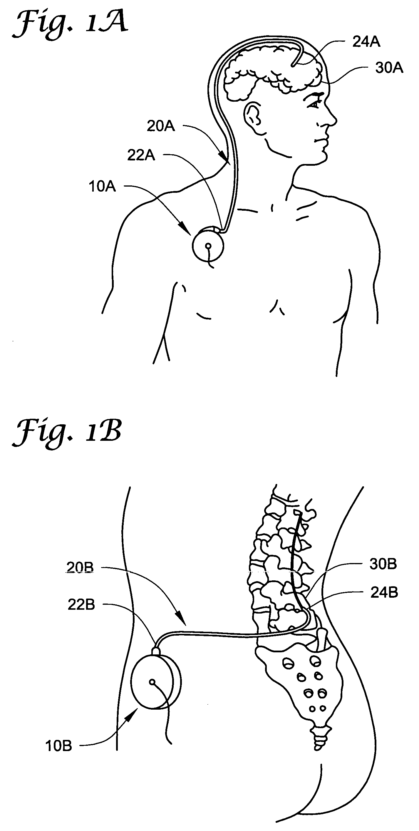 Permeable membrane catheters, systems, and methods