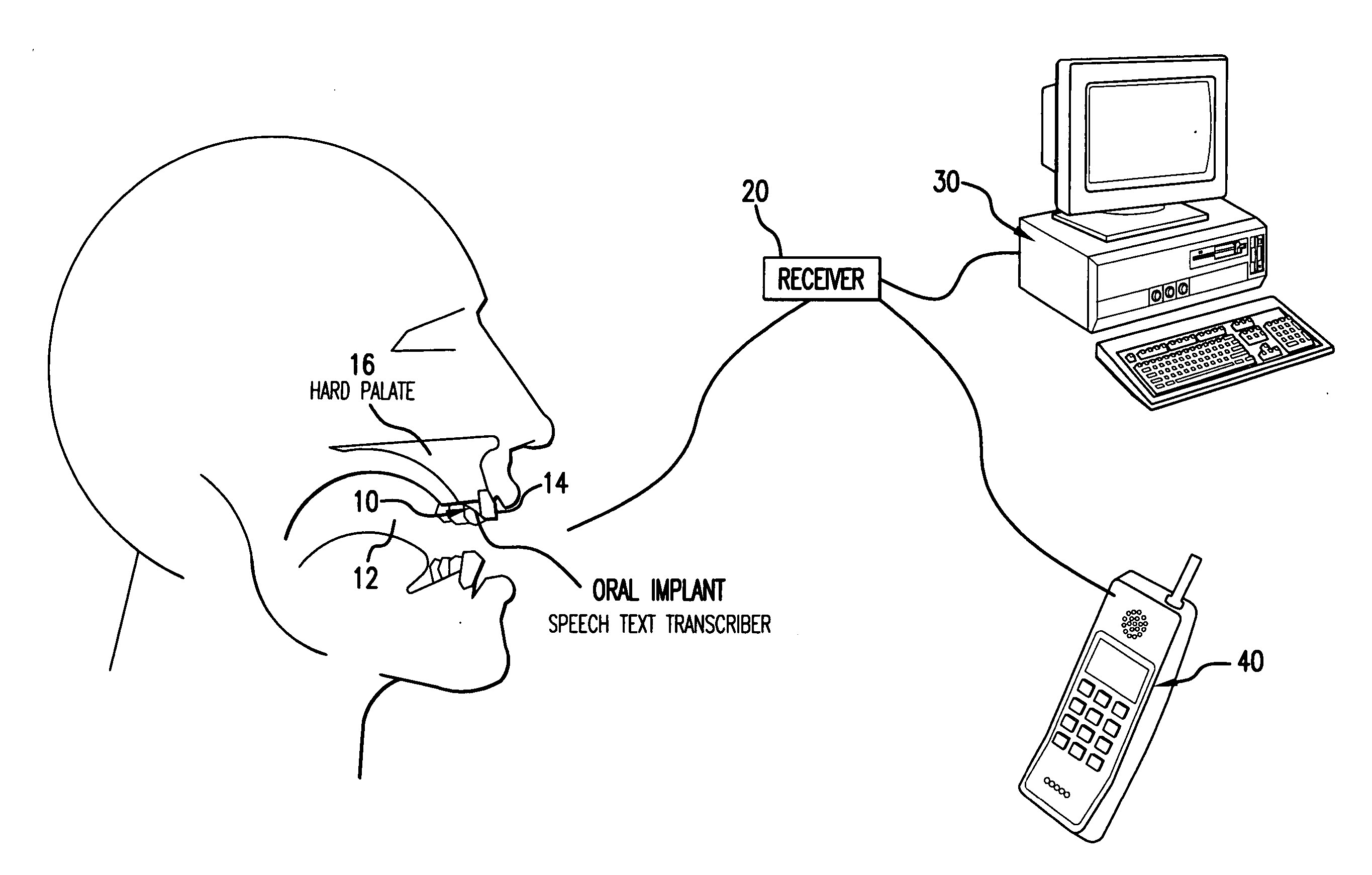 Orally mounted wireless transcriber device