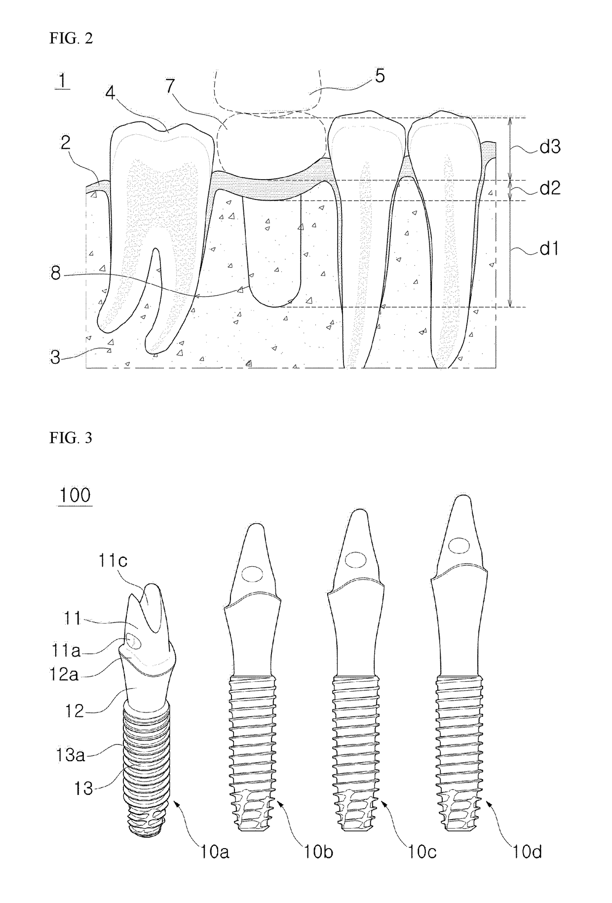 Dental implant prosthesis using digital library and method for manufacturing same