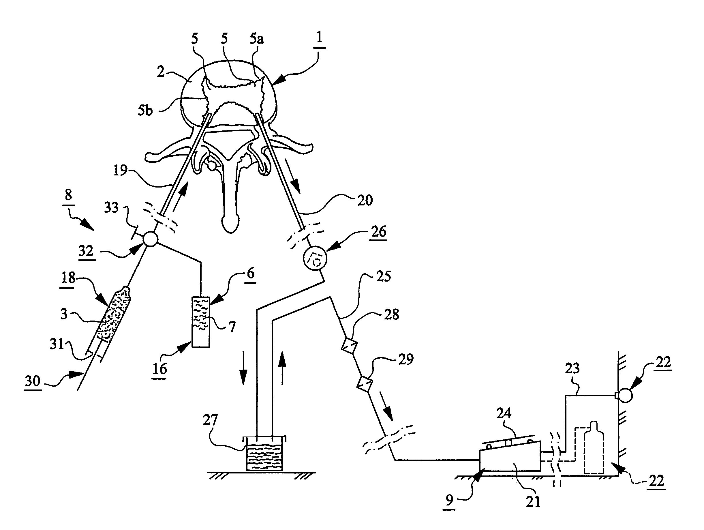 Device for providing spongy bone with bone substitute and/or bone reinforcing material, bone substitute and/or bone reinforcing material and method