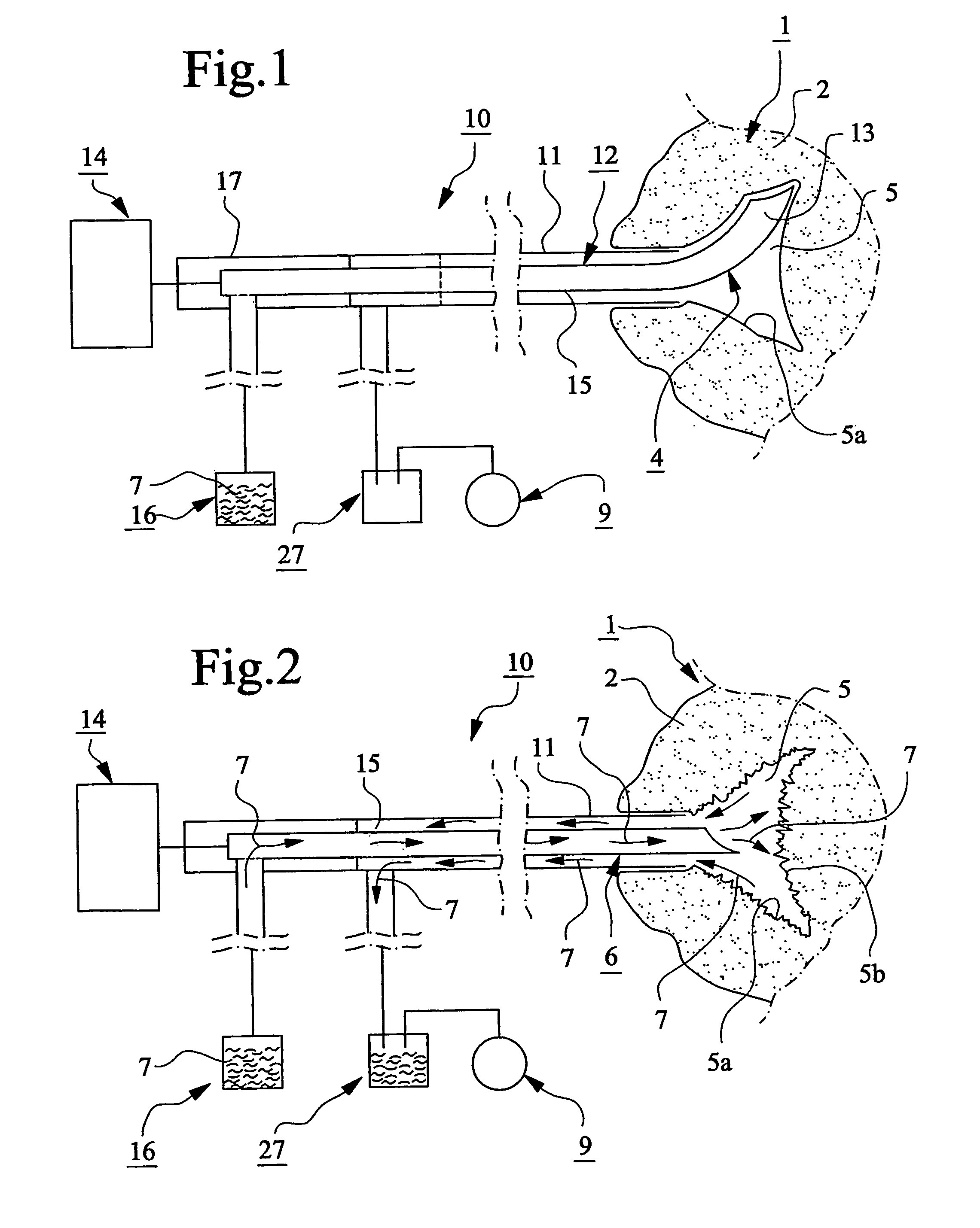 Device for providing spongy bone with bone substitute and/or bone reinforcing material, bone substitute and/or bone reinforcing material and method