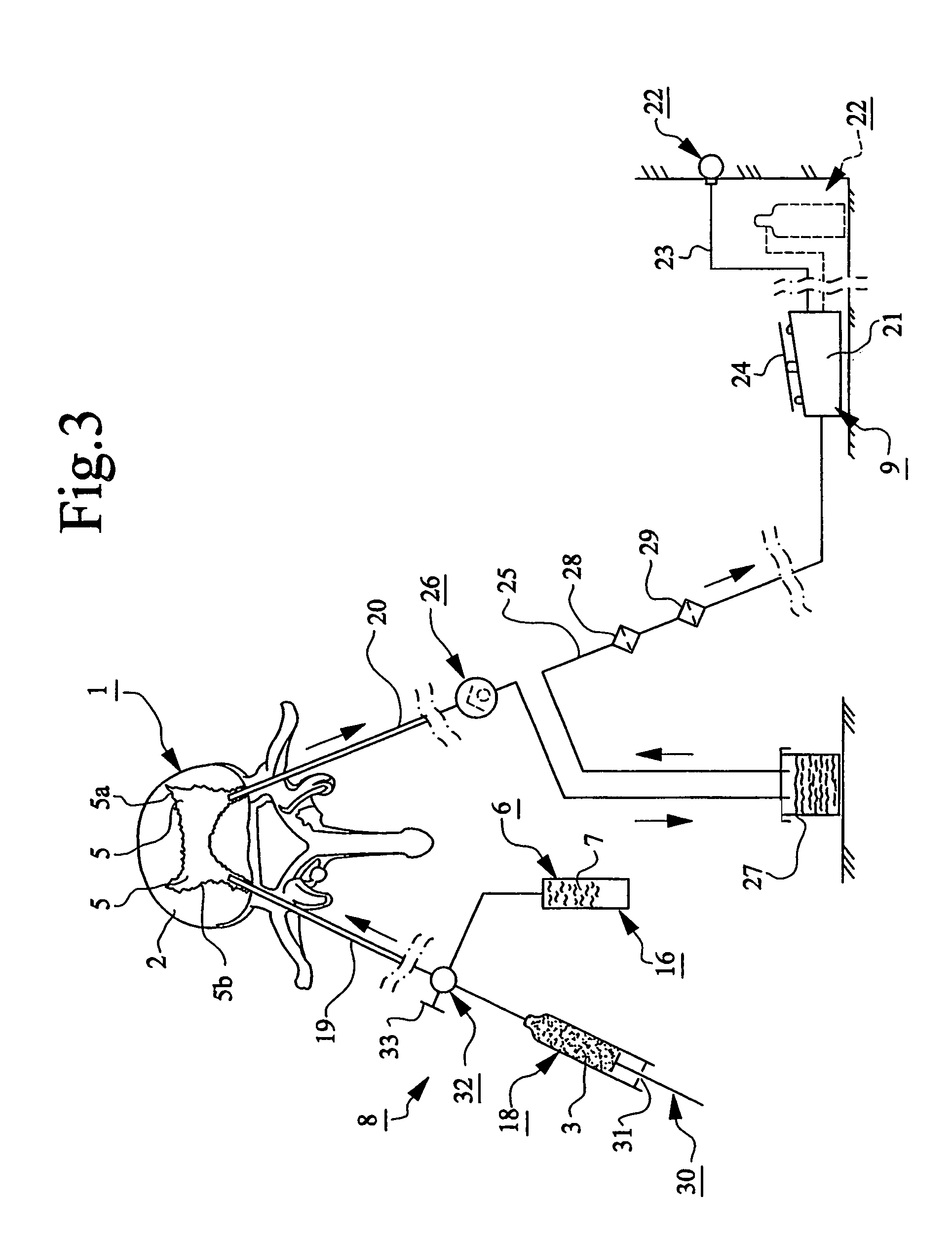 Device for providing spongy bone with bone substitute and/or bone reinforcing material, bone substitute and/or bone reinforcing material and method