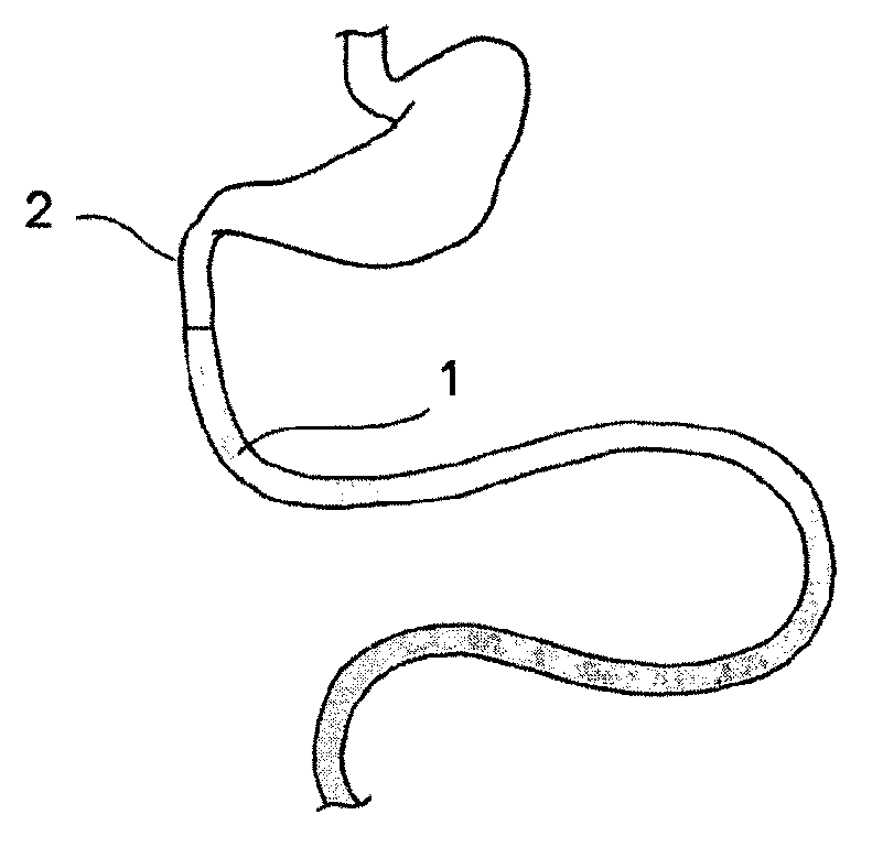 An endoluminal lining and a method for endoluminally lining a hollow organ